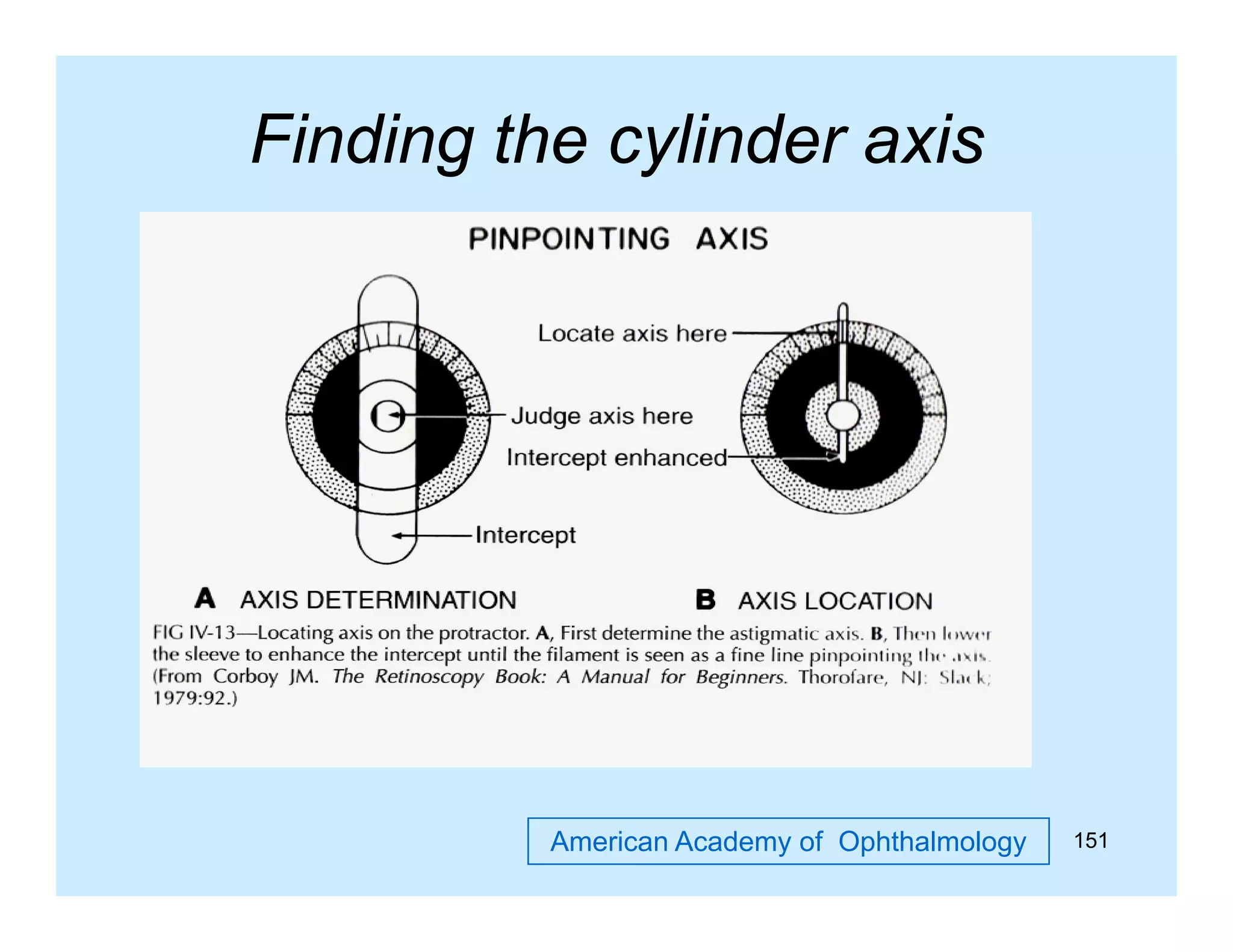 Finding the cylinder axis
g
y

American Academy of Ophthalmology

151

 