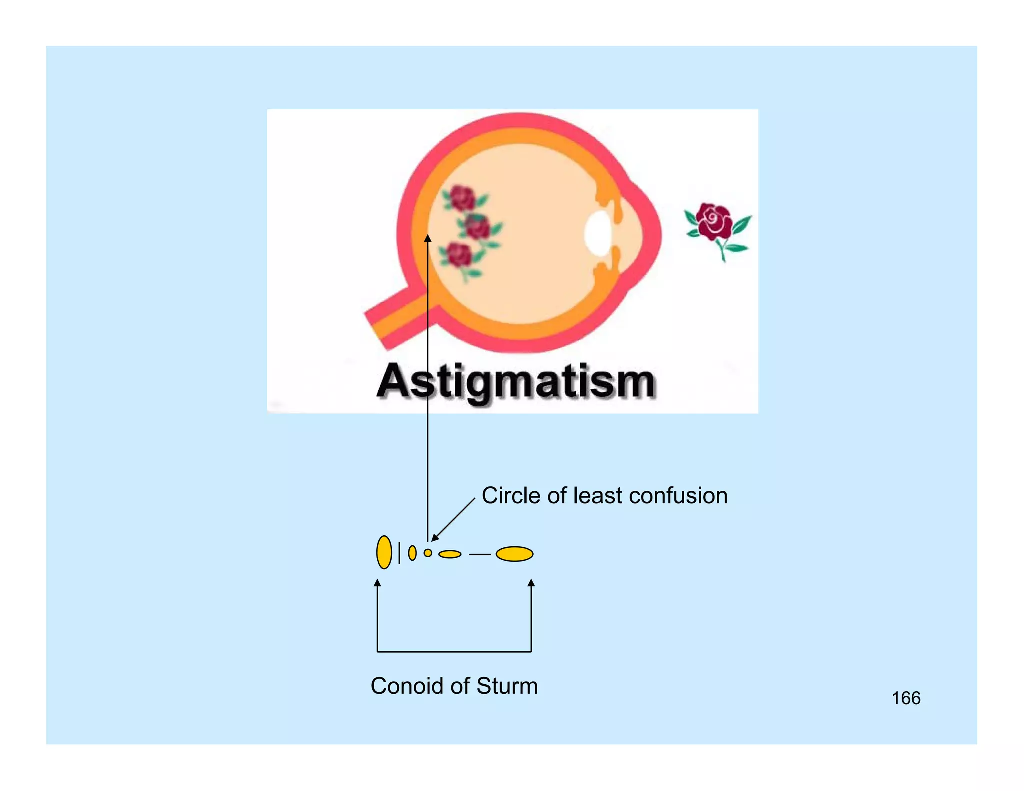 Circle of least confusion

Conoid of Sturm

166

 