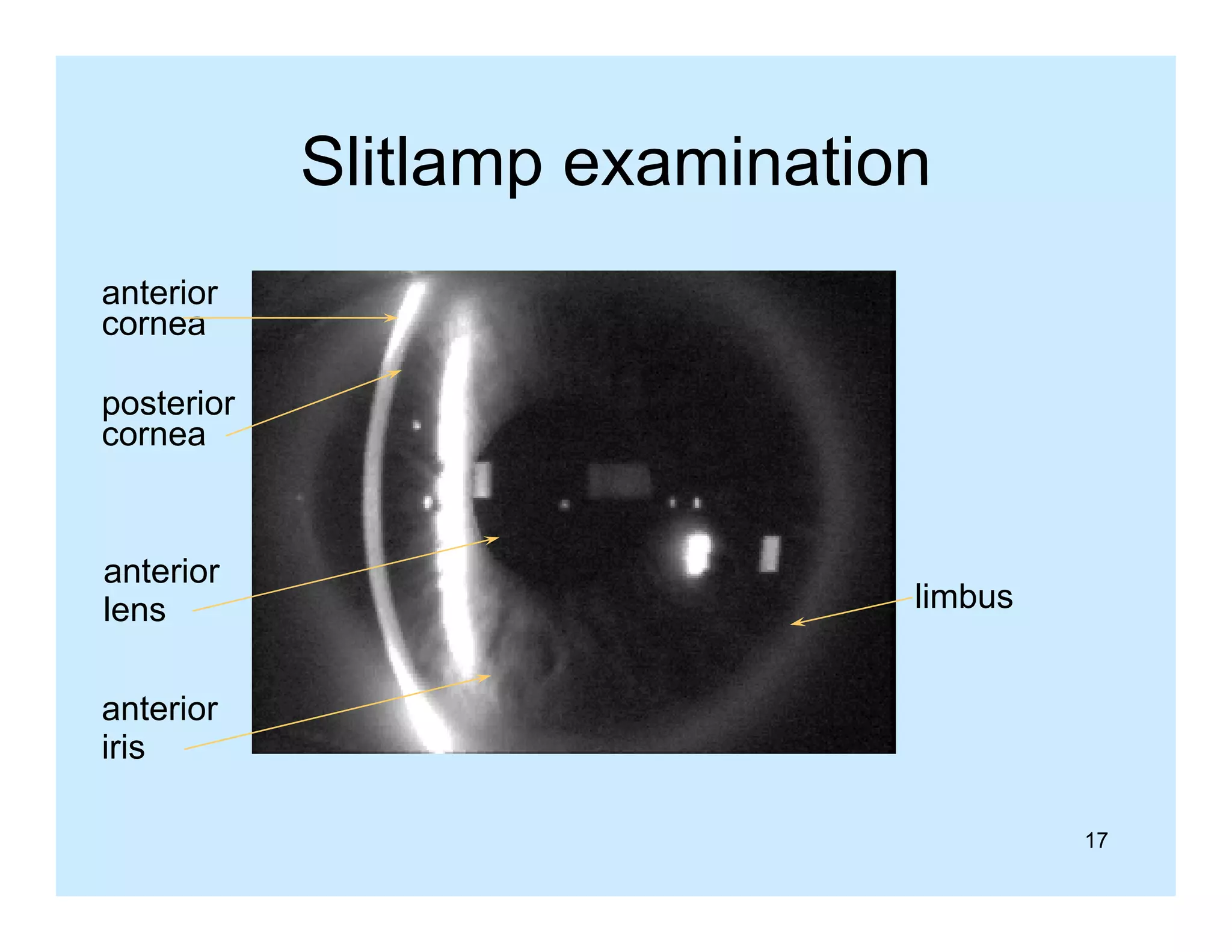 Slitlamp examination
anterior
cornea
p
posterior
cornea

anterior
lens

limbus

anterior
iris
17

 