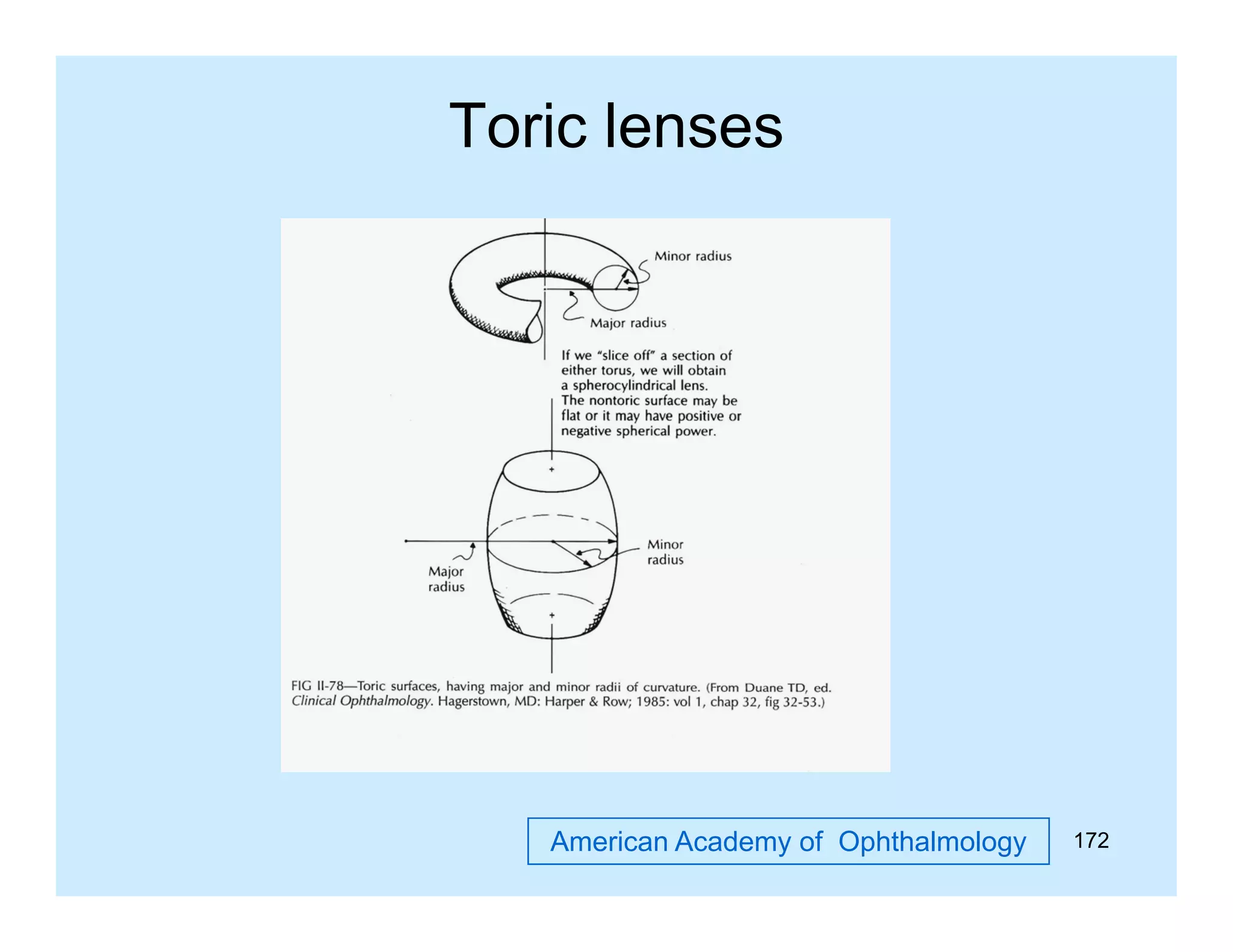 Toric lenses

American Academy of Ophthalmology

172

 
