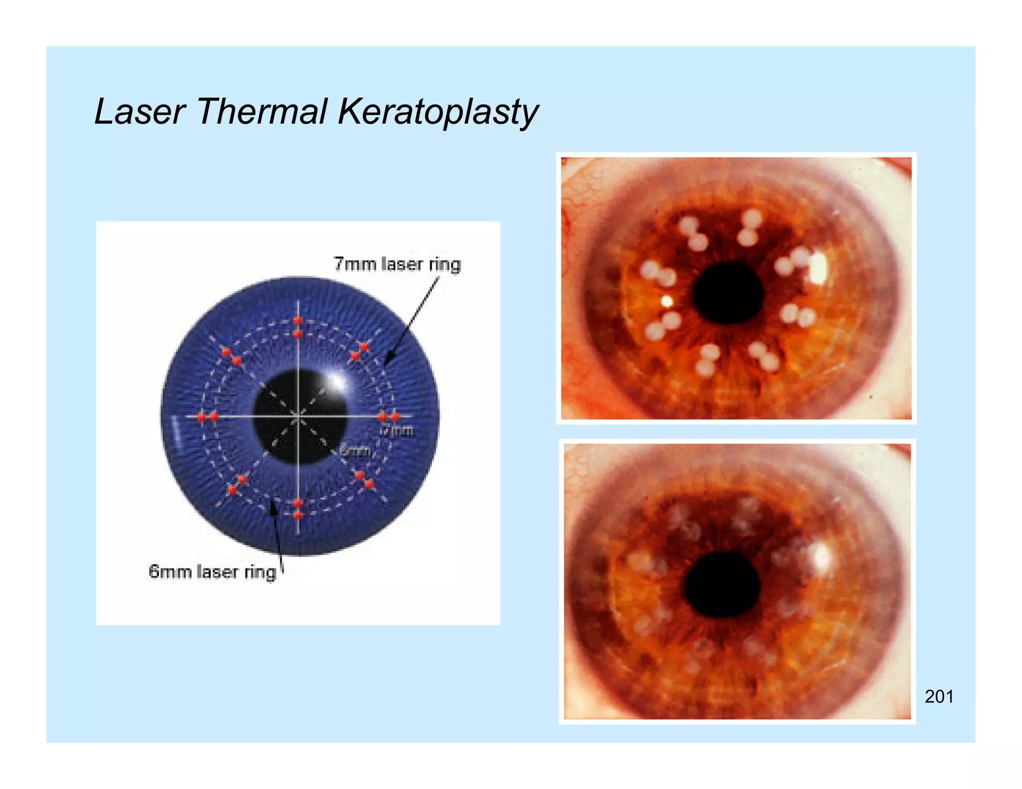 Laser Thermal Keratoplasty

201

 