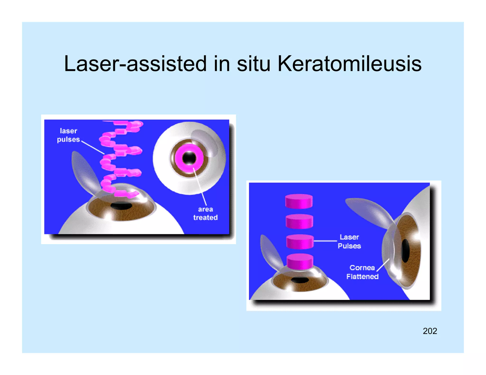 Laser assisted
Laser-assisted in situ Keratomileusis

202

 