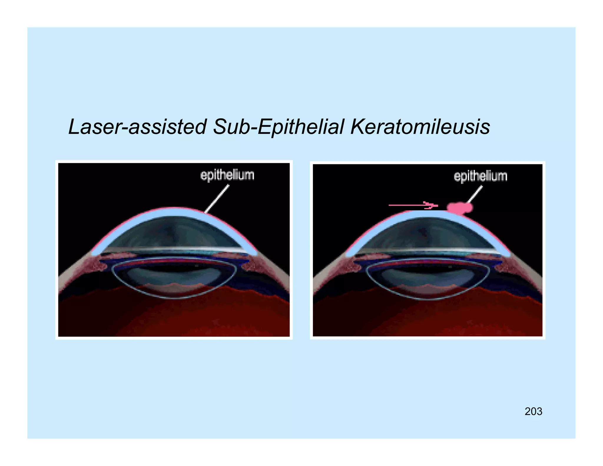 Laser-assisted Sub-Epithelial Keratomileusis

203

 