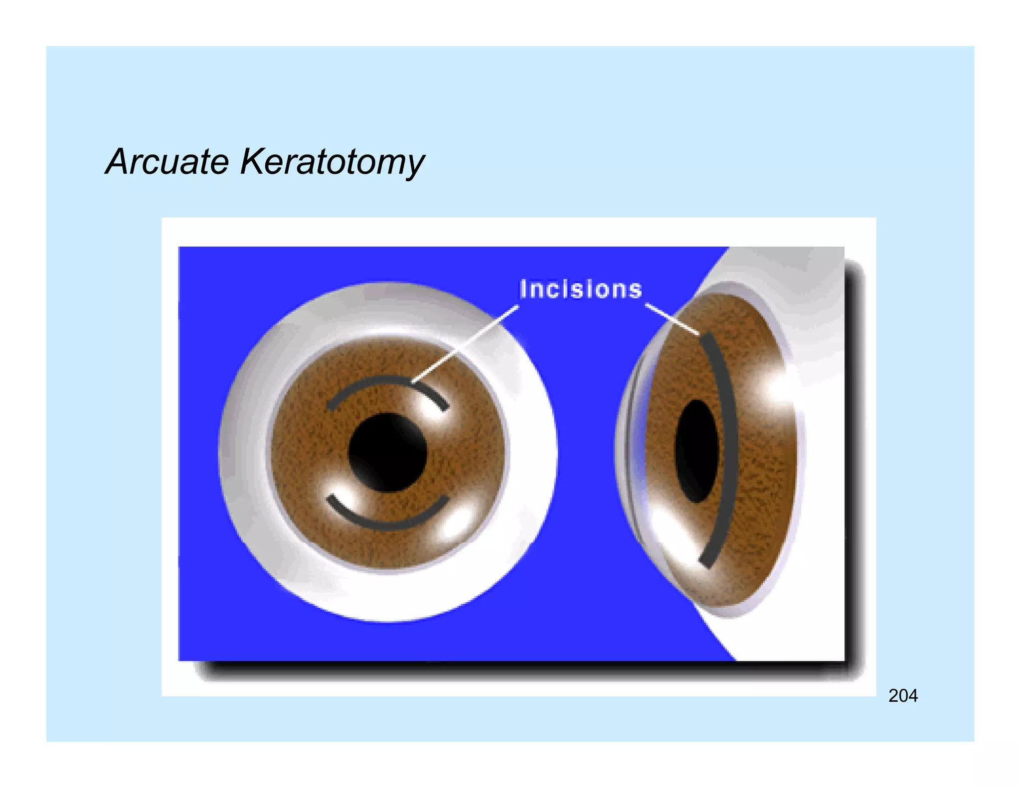 Arcuate Keratotomy

204

 