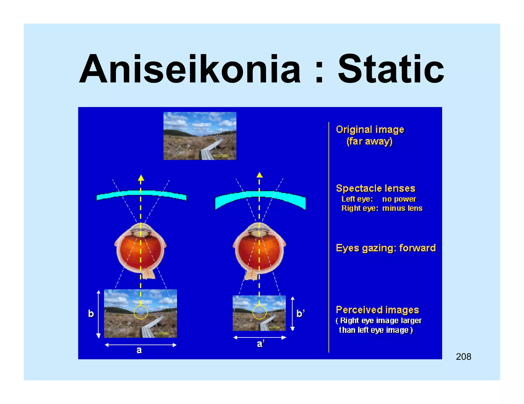 Aniseikonia : Static

208

 