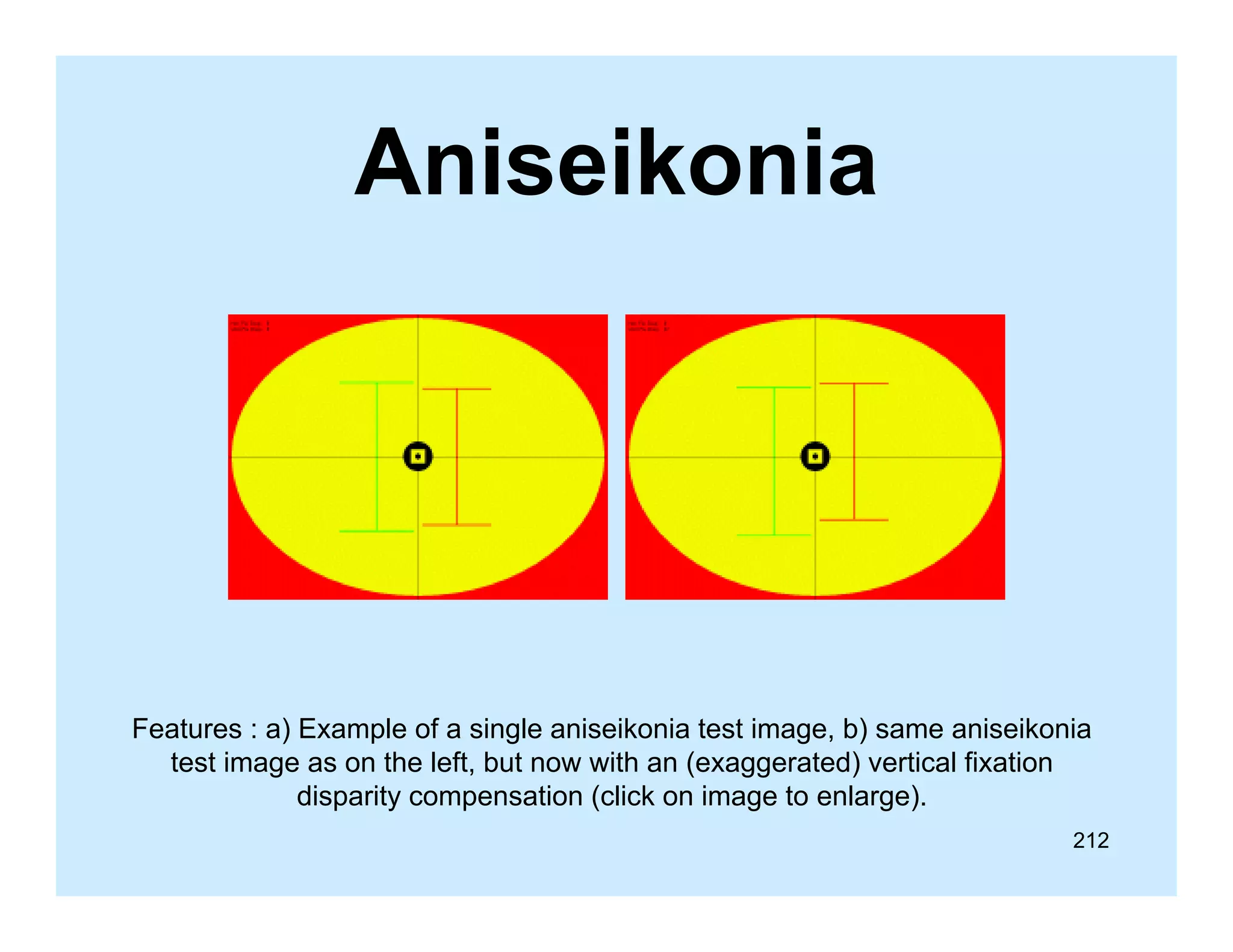 Aniseikonia

Features : a) Example of a single aniseikonia test image, b) same aniseikonia
test image as on the left, but now with an (exaggerated) vertical fixation
g
,
(
gg
)
disparity compensation (click on image to enlarge).
212

 