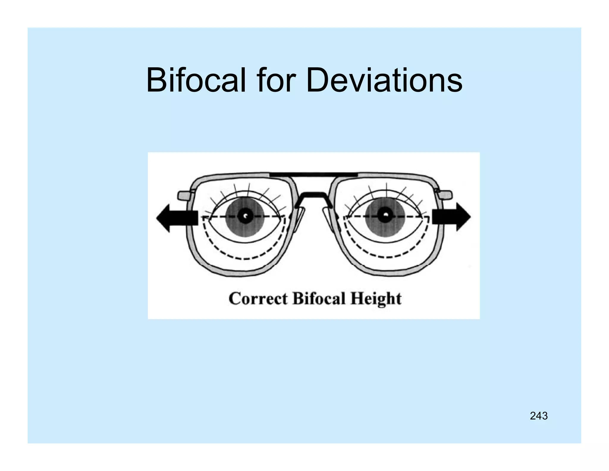 Bifocal for Deviations

243

 