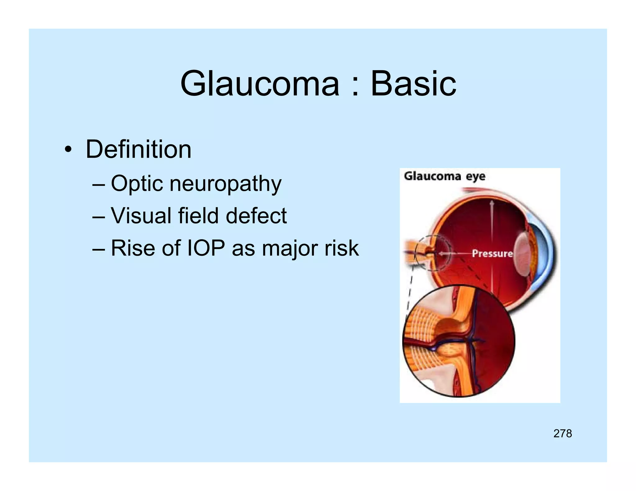 Glaucoma : Basic
• Definition
– Optic neuropathy
– Visual field defect
– Rise of IOP as major risk

278

 