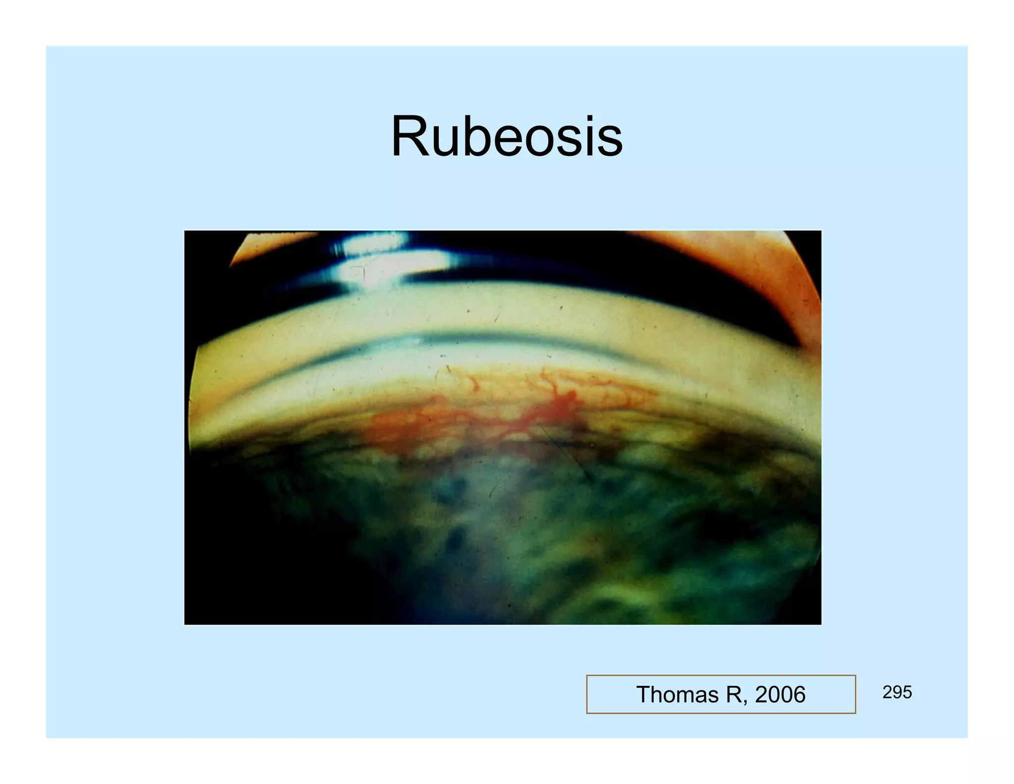 Rubeosis

Thomas R, 2006

295

 
