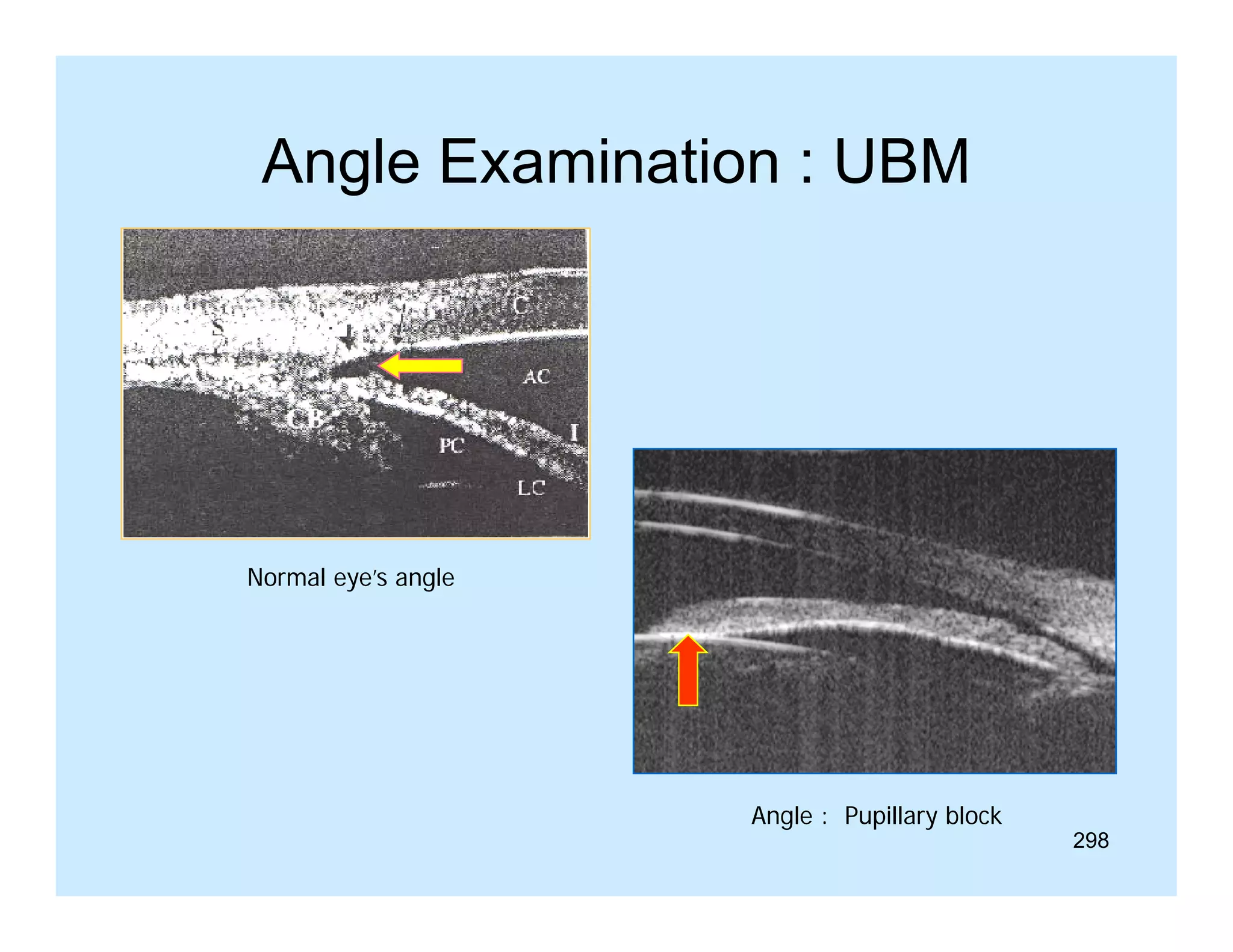 Angle Examination : UBM

Normal eye’s angle

Angle : Pupillary block

298

 