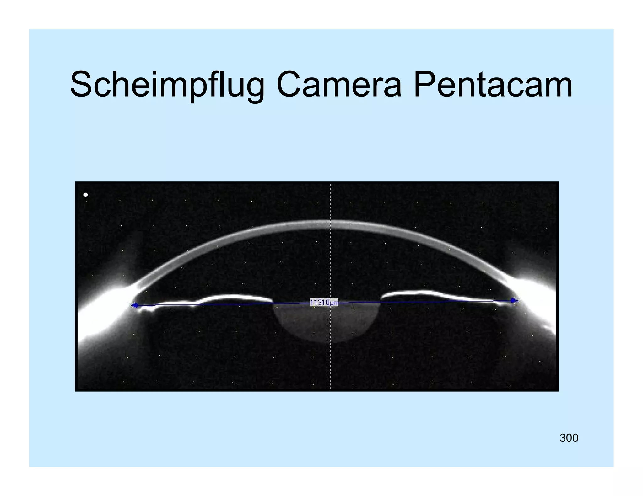 Scheimpflug Camera Pentacam

300

 