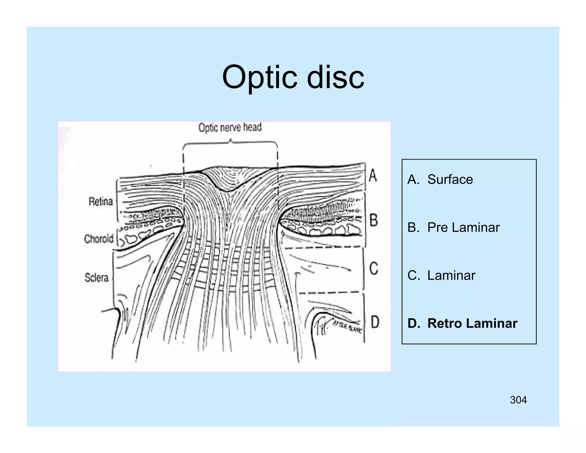 Optic disc
A. Surface
B. Pre Laminar
C. Laminar
D. Retro Laminar

304

 
