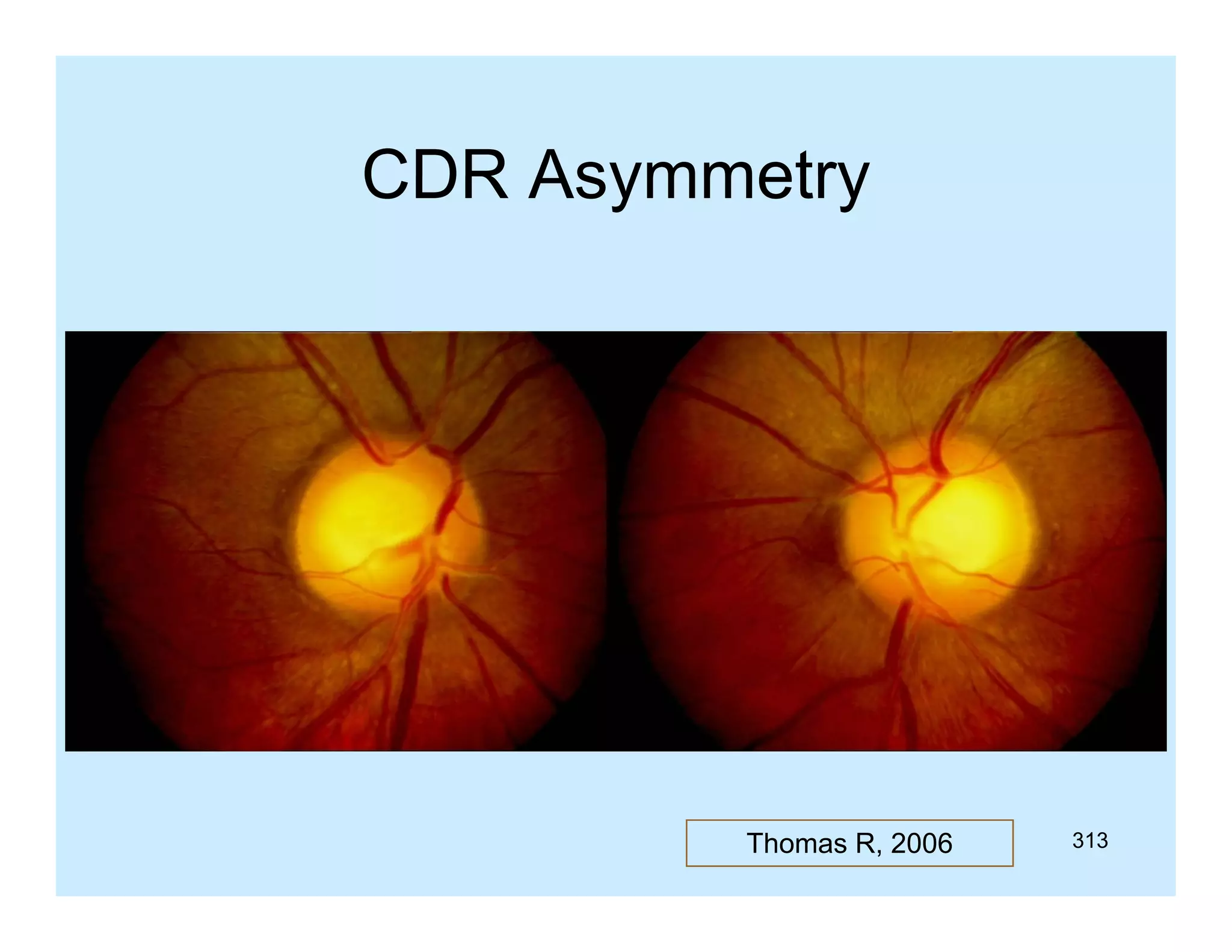 CDR Asymmetry

Thomas R, 2006

313

 