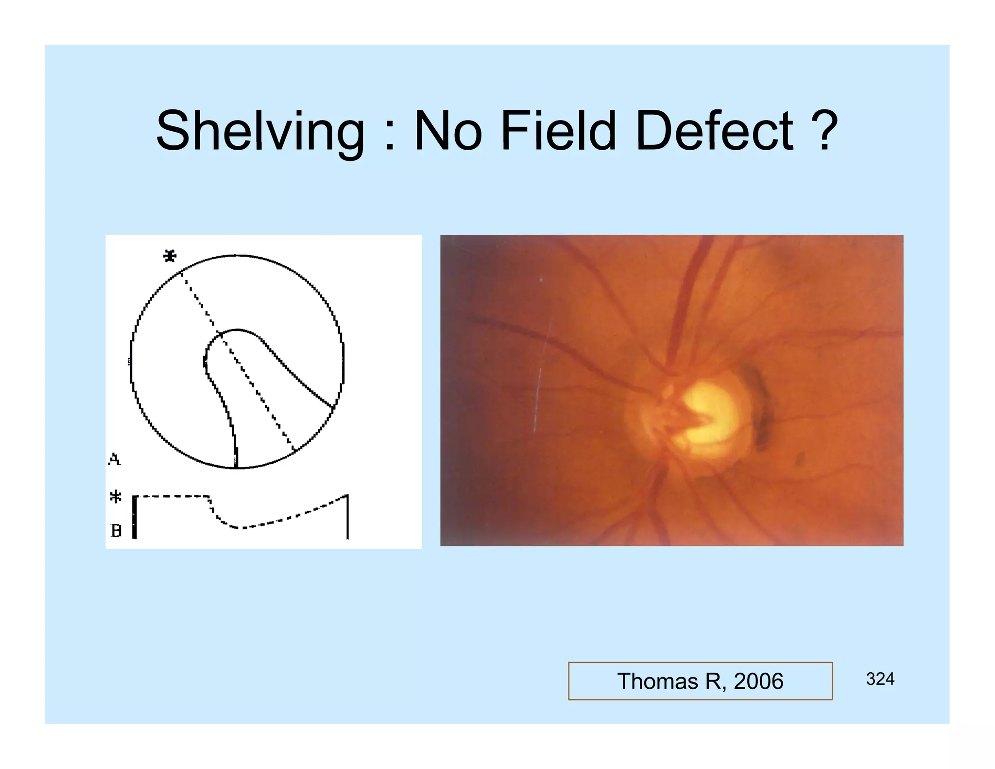 Shelving : No Field Defect ?

Thomas R, 2006

324

 