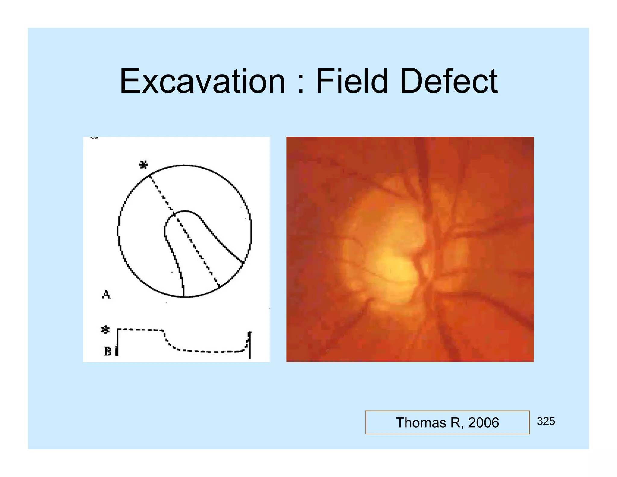 Excavation : Field Defect

Thomas R, 2006

325

 
