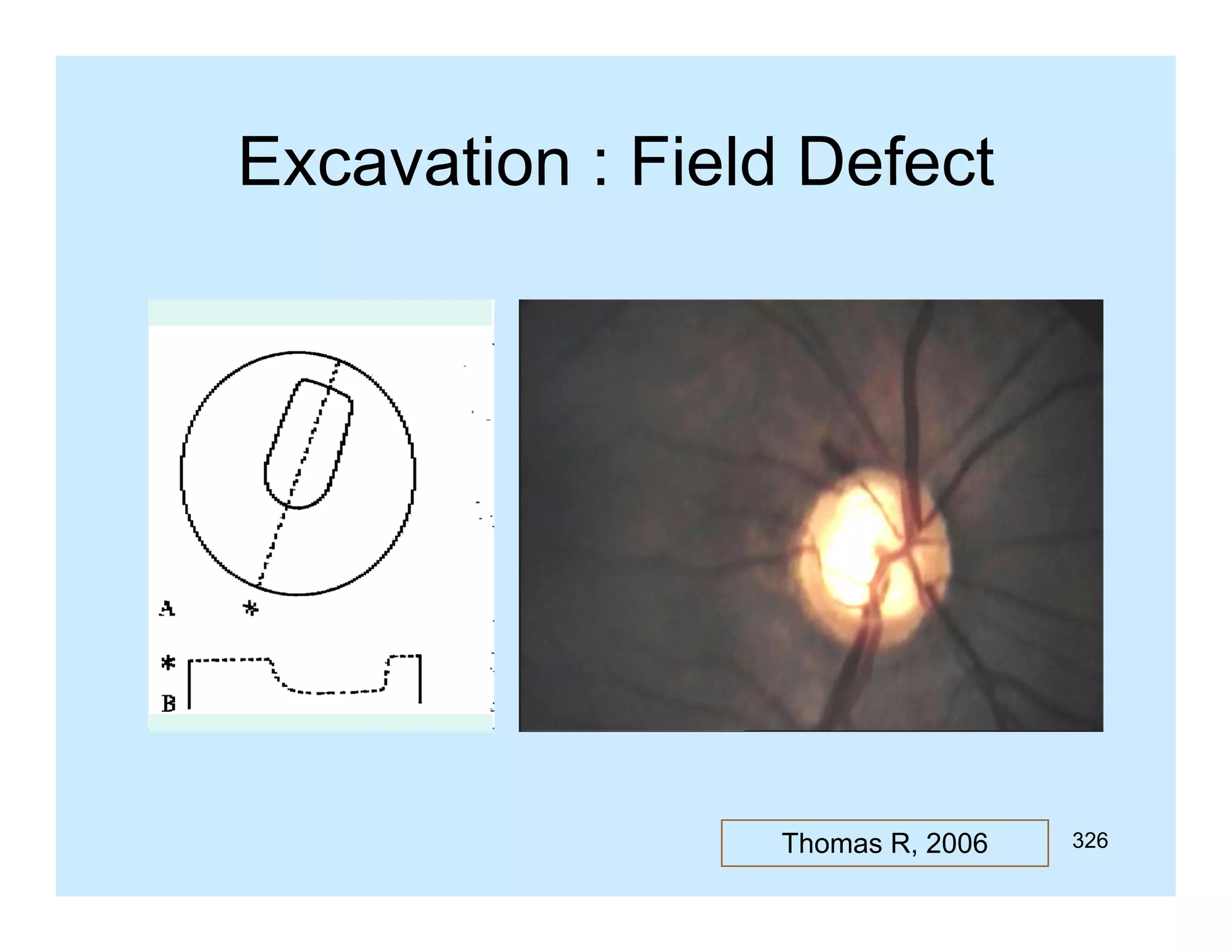 Excavation : Field Defect

Thomas R, 2006

326

 