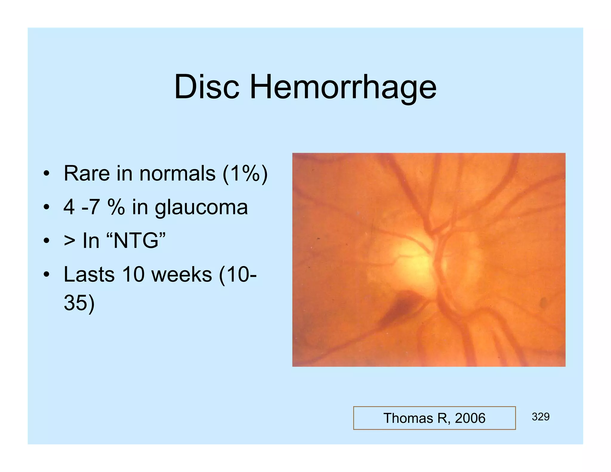 Disc Hemorrhage
• Rare in normals (1%)
• 4 -7 % in glaucoma
7
• > In “NTG”
• Lasts 10 weeks (1035)

Thomas R, 2006

329

 