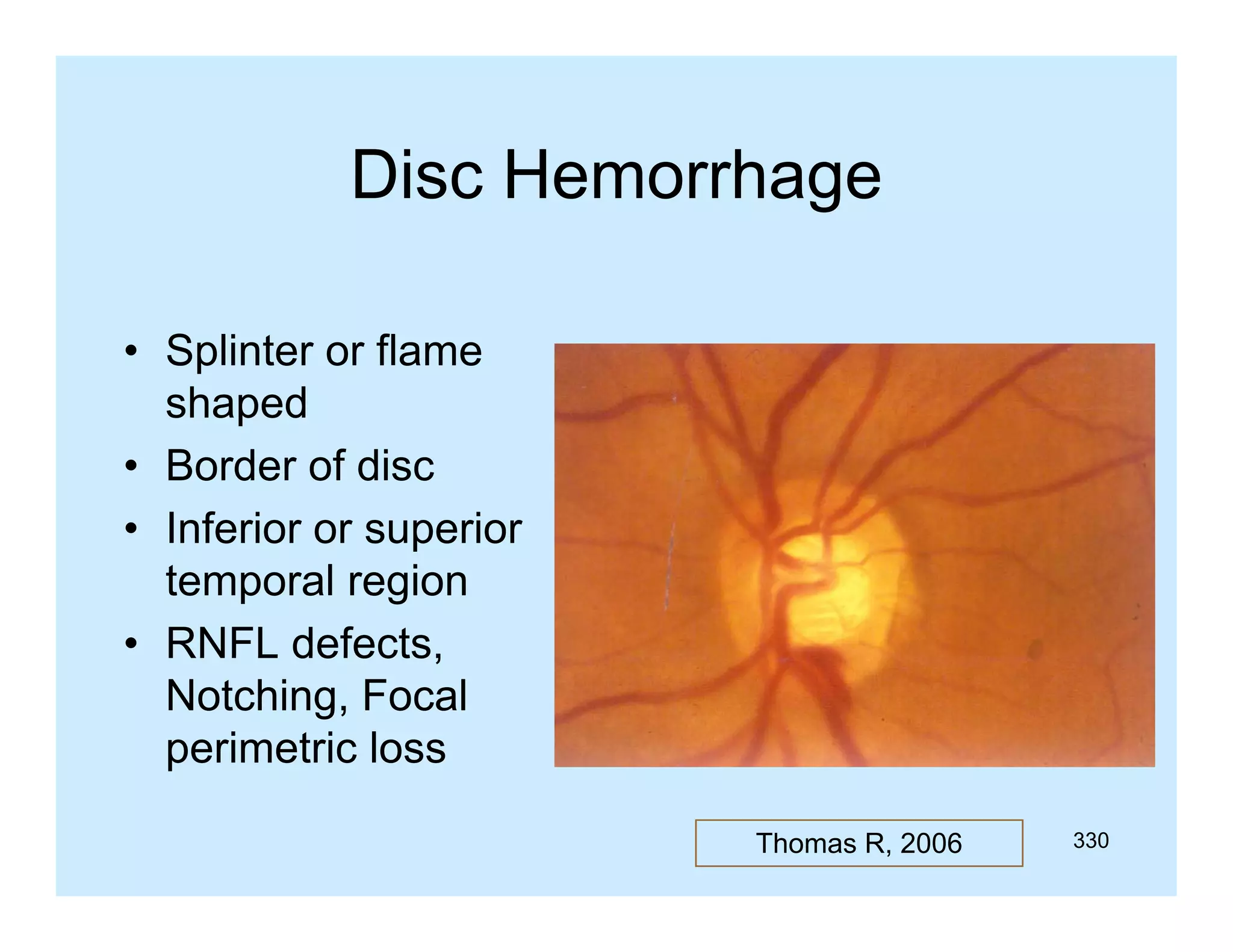 Disc Hemorrhage
• Splinter or flame
shaped
• Border of disc
• Inferior or superior
temporal region
• RNFL defects,
Notching, Focal
perimetric loss
Thomas R, 2006

330

 