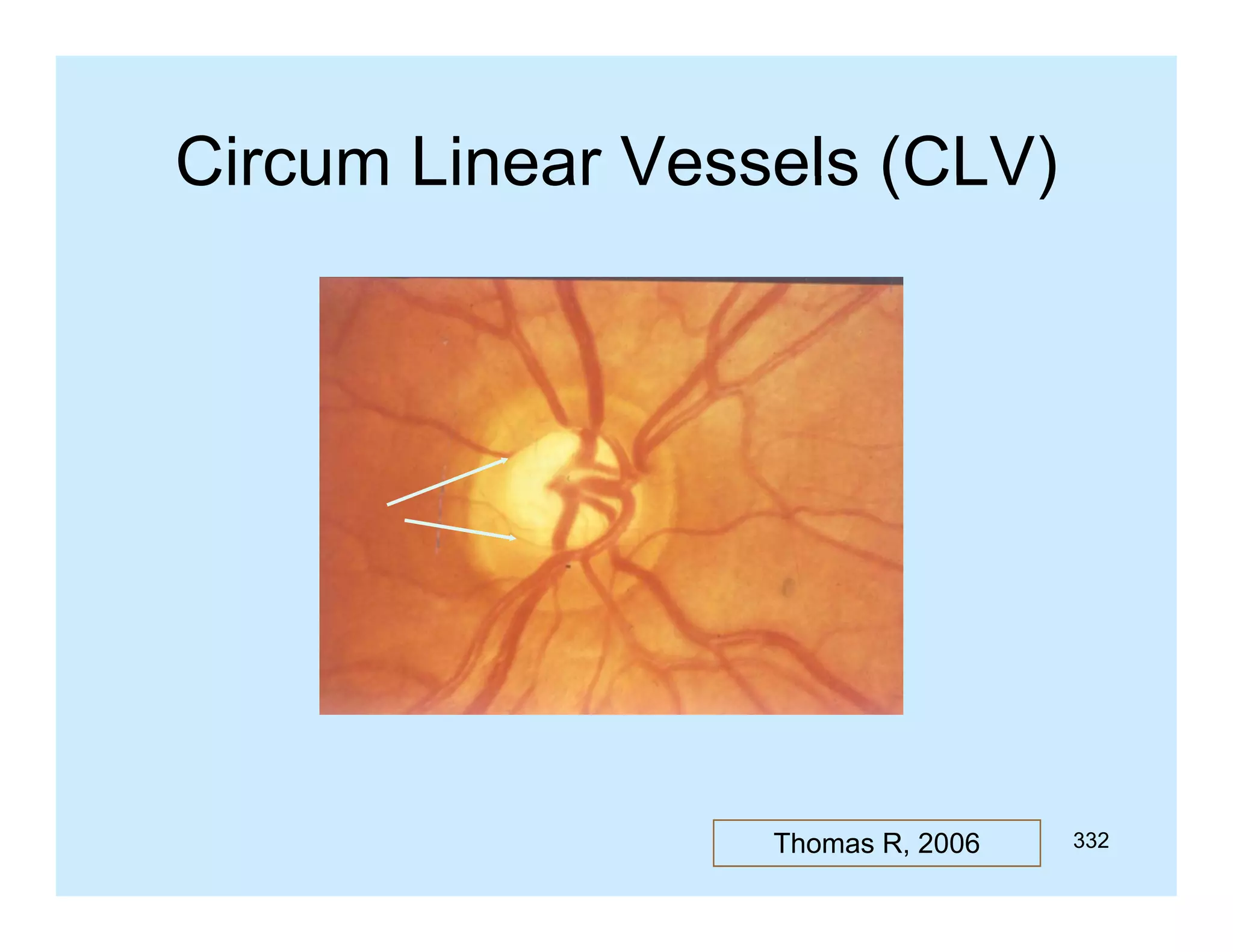 Circum Linear Vessels (CLV)

Thomas R, 2006

332

 