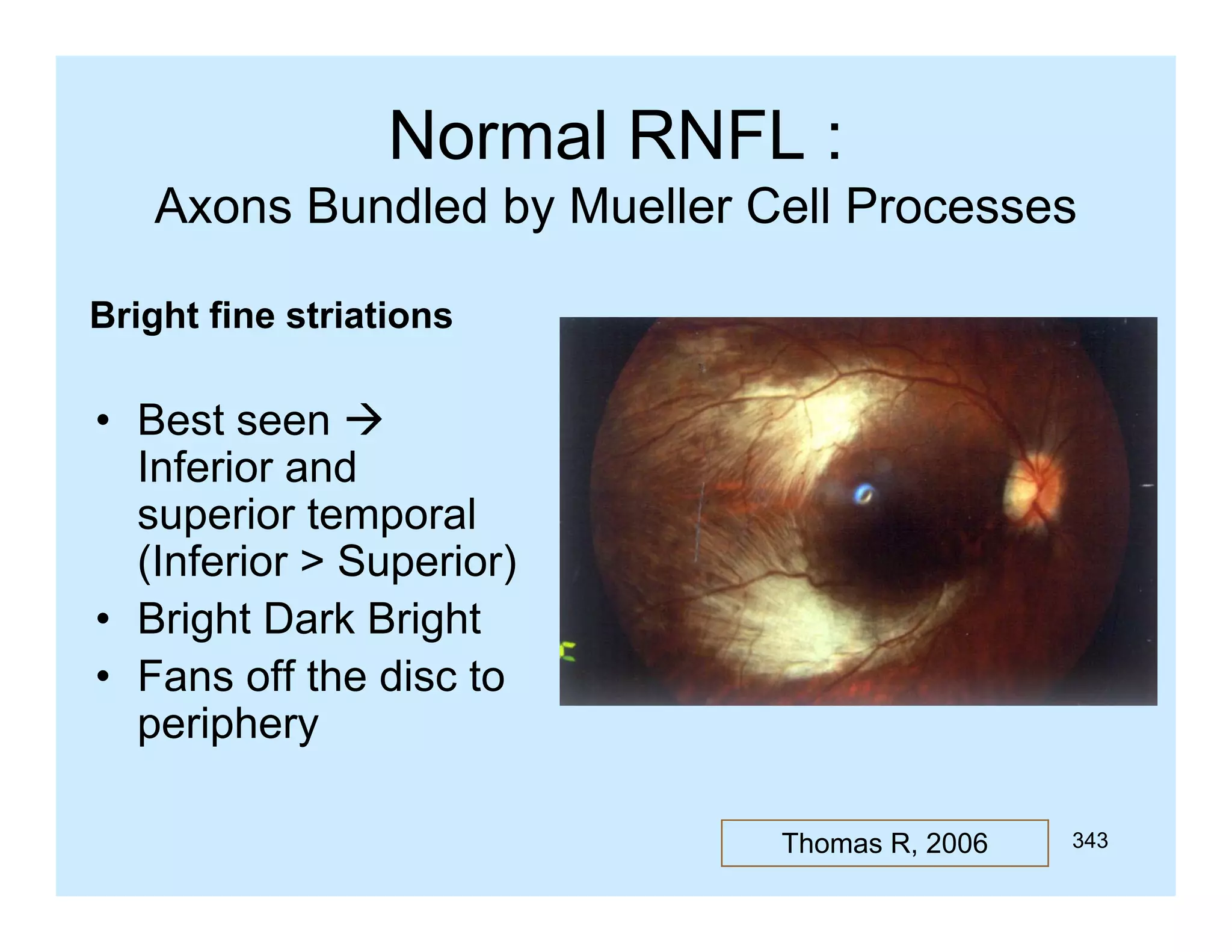 Normal RNFL :
Axons Bundled by Mueller Cell Processes
Bright fine striations

• Best seen 
Inferior and
superior temporal
p
p
(Inferior > Superior)
• Bright Dark Bright
• Fans off the disc to
periphery
Thomas R, 2006

343

 