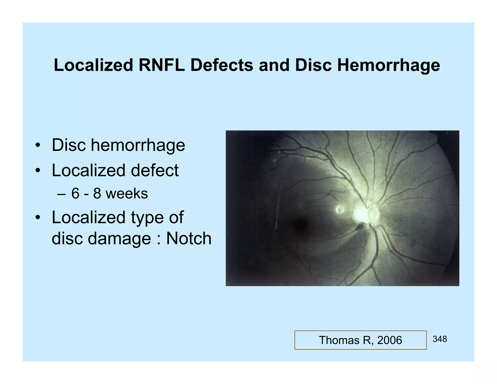 Localized RNFL Defects a d Disc Hemorrhage
oca ed
e ects and sc e o age

• Disc hemorrhage
• Localized defect
– 6 - 8 weeks

• Localized type of
disc damage : Notch

Thomas R, 2006

348

 