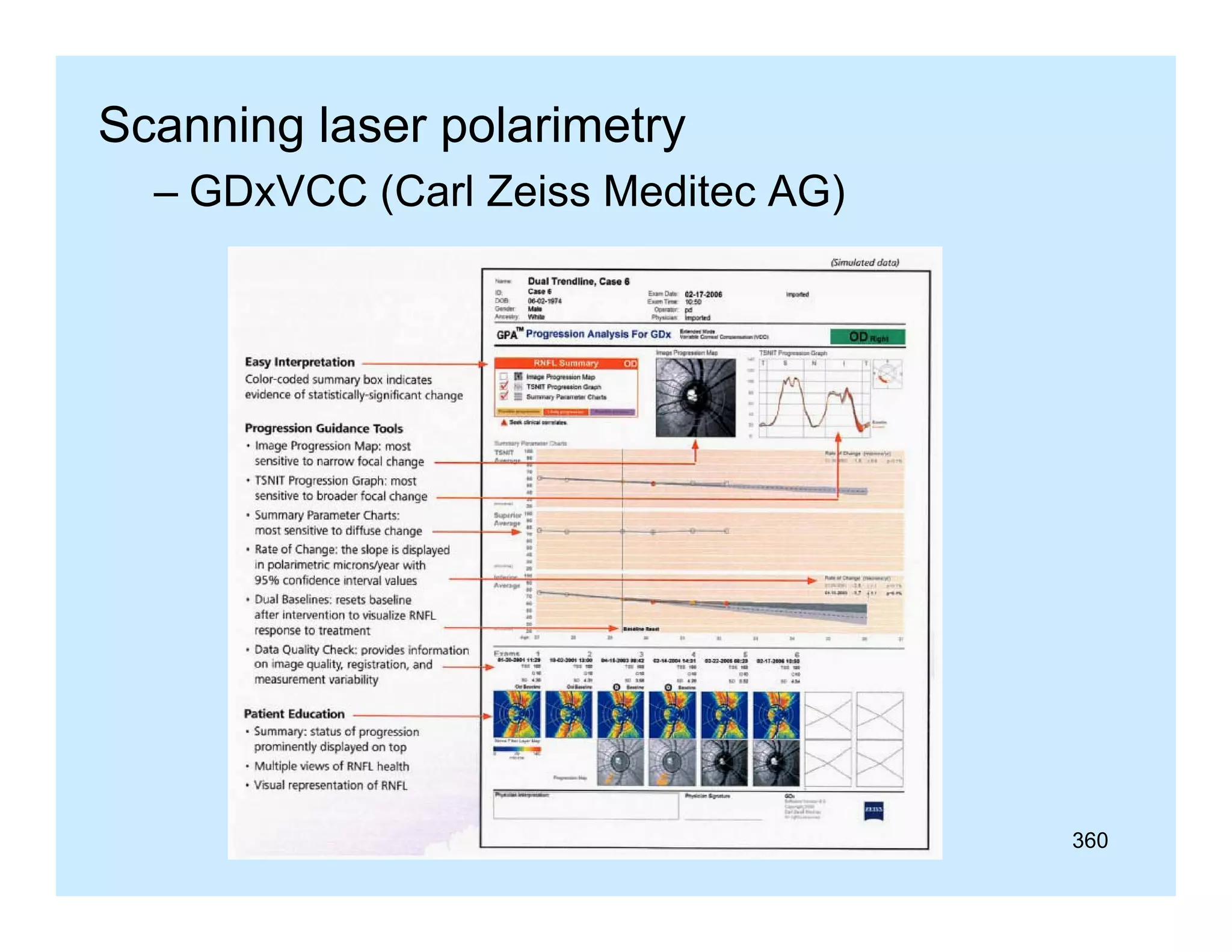Scanning laser polarimetry
– GD VCC (Carl Zeiss Meditec AG)
GDxVCC (C l Z i M dit

360

 