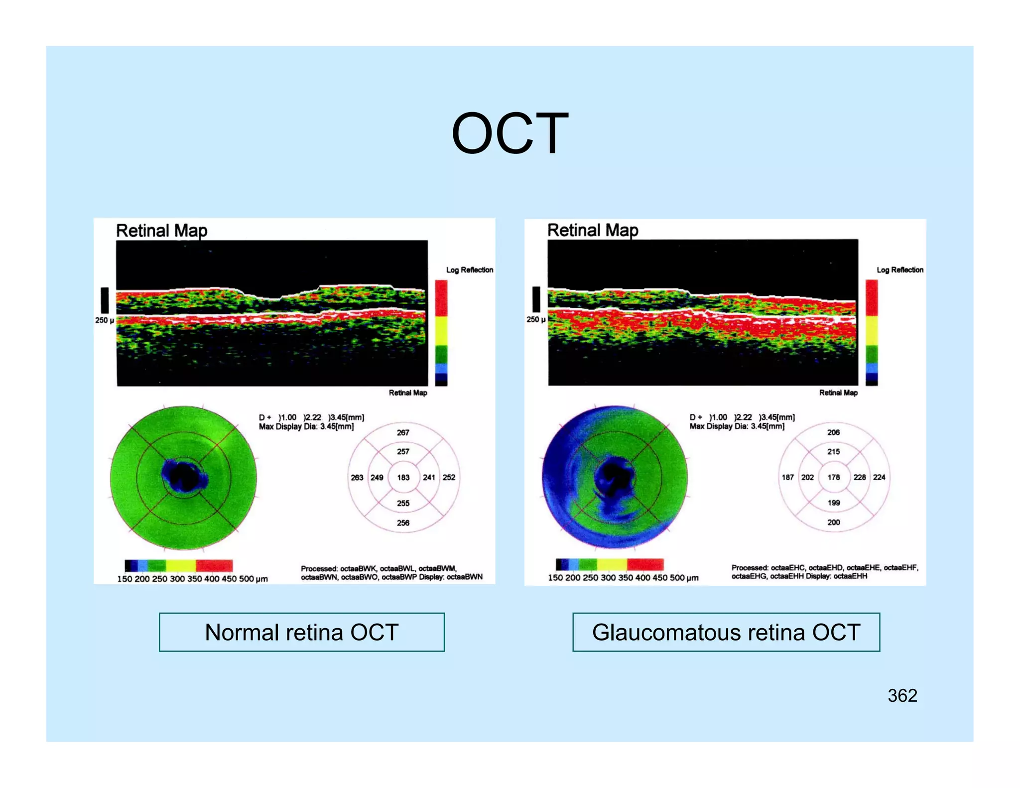 OCT

Normal retina OCT

Glaucomatous retina OCT
362

 