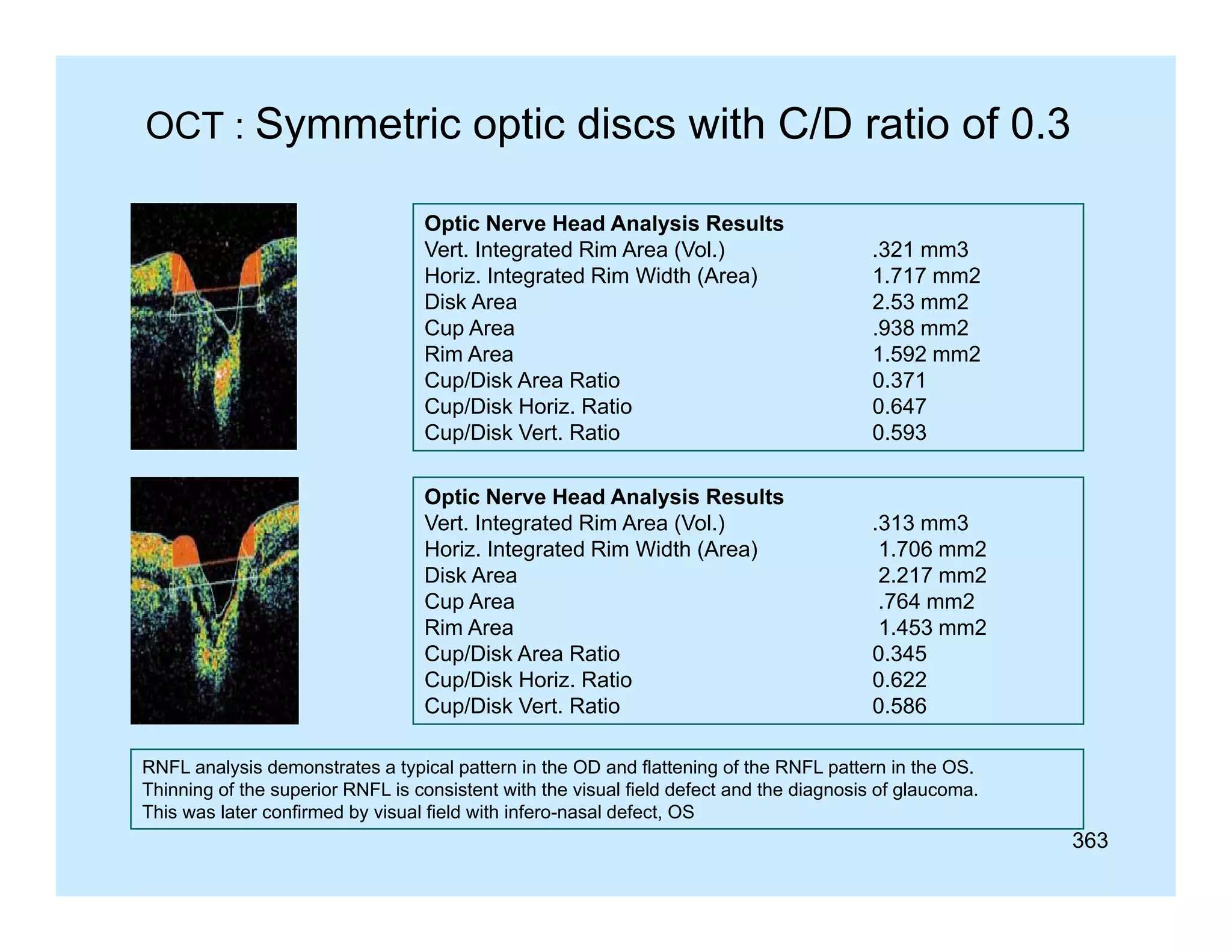 OCT : Symmetric optic discs with C/D ratio of 0.3
Optic Nerve Head Analysis Results
Vert. Integrated Rim Area (Vol.)
Horiz. Integrated Rim Width (Area)
Disk Area
Di k A
Cup Area
Rim Area
Cup/Disk Area Ratio
Cup/Disk Horiz. Ratio
p
Cup/Disk Vert. Ratio

.321 mm3
1.717 mm2
2.53
2 53 mm2
2
.938 mm2
1.592 mm2
0.371
0.647
0.593

Optic Nerve Head Analysis Results
Vert. Integrated Rim Area (Vol.)
Horiz. Integrated Rim Width (Area)
Disk Area
Cup Area
Rim Area
Cup/Disk Area Ratio
Cup/Disk Horiz. Ratio
Cup/Disk Vert. Ratio

.313 mm3
1.706 mm2
2.217 mm2
.764 mm2
1.453 mm2
0.345
0 345
0.622
0.586

RNFL analysis demonstrates a typical p
y
yp
pattern in the OD and flattening of the RNFL p
g
pattern in the OS.
Thinning of the superior RNFL is consistent with the visual field defect and the diagnosis of glaucoma.
This was later confirmed by visual field with infero-nasal defect, OS

363

 