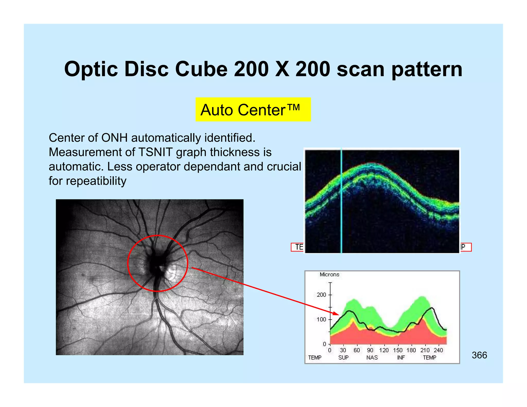 Optic Disc Cube 200 X 200 scan pattern
Auto Center™
Center of ONH automatically identified.
Measurement of TSNIT graph thickness is
automatic. Less operator dependant and crucial
for
f repeatibility
tibilit

366

 