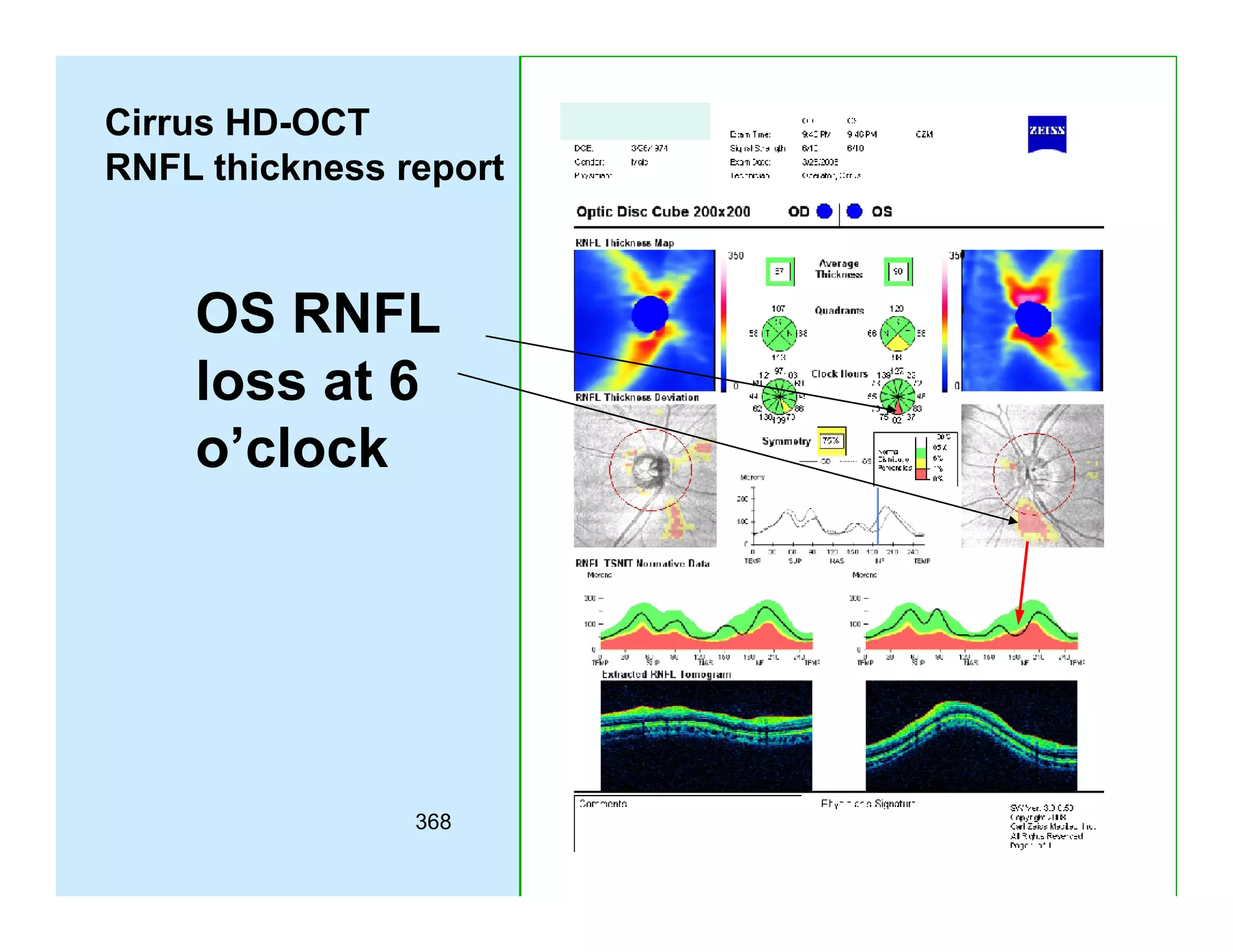 Cirrus HD-OCT
RNFL thickness report

OS RNFL
loss at 6
o’clock

368

 