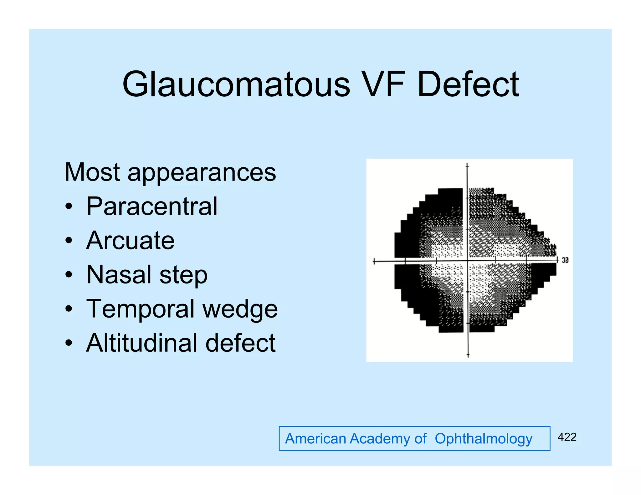 Glaucomatous VF Defect
Most appearances
• Paracentral
• Arcuate
• Nasal step
• Temporal wedge
• Altitudinal defect

American Academy of Ophthalmology

422

 