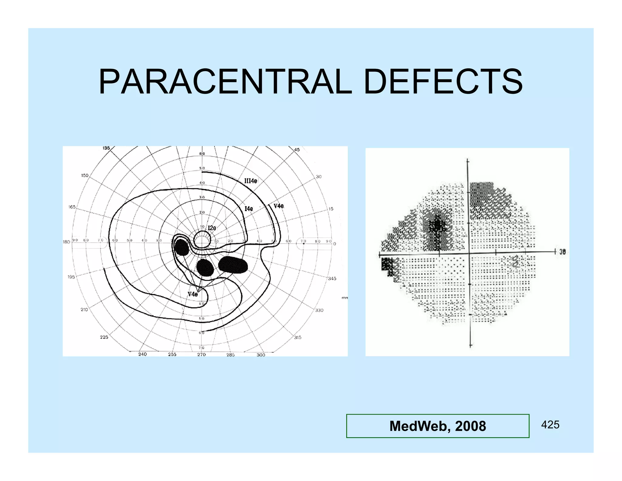 PARACENTRAL DEFECTS

MedWeb, 2008

425

 