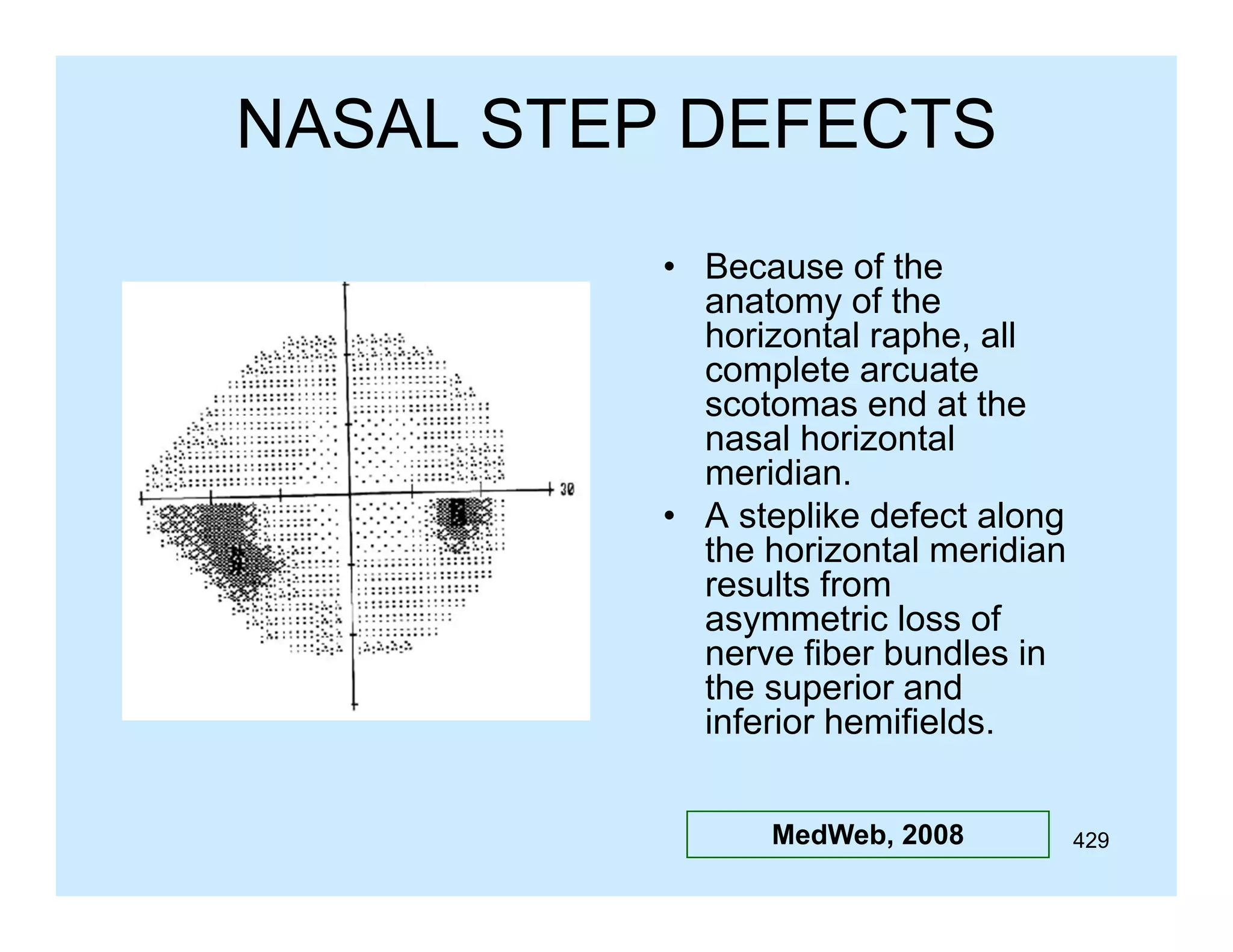 NASAL STEP DEFECTS
• Because of the
anatomy of the
horizontal raphe, all
complete arcuate
scotomas end at the
nasal horizontal
meridian.
• A steplike defect along
the horizontal meridian
results from
asymmetric loss of
nerve fiber bundles in
the superior and
inferior hemifields.
MedWeb, 2008

429

 