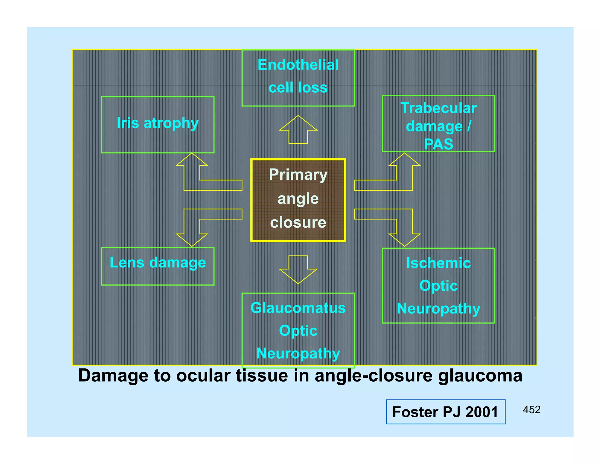Endothelial
cell loss
Trabecular
damage /
PAS

Iris atrophy

Primary
angle
closure
Lens damage

Ischemic
Optic
Glaucomatus

Neuropathy

Optic
Neuropathy

Damage to ocular tissue in angle-closure glaucoma
angle closure
Foster PJ 2001

452

 