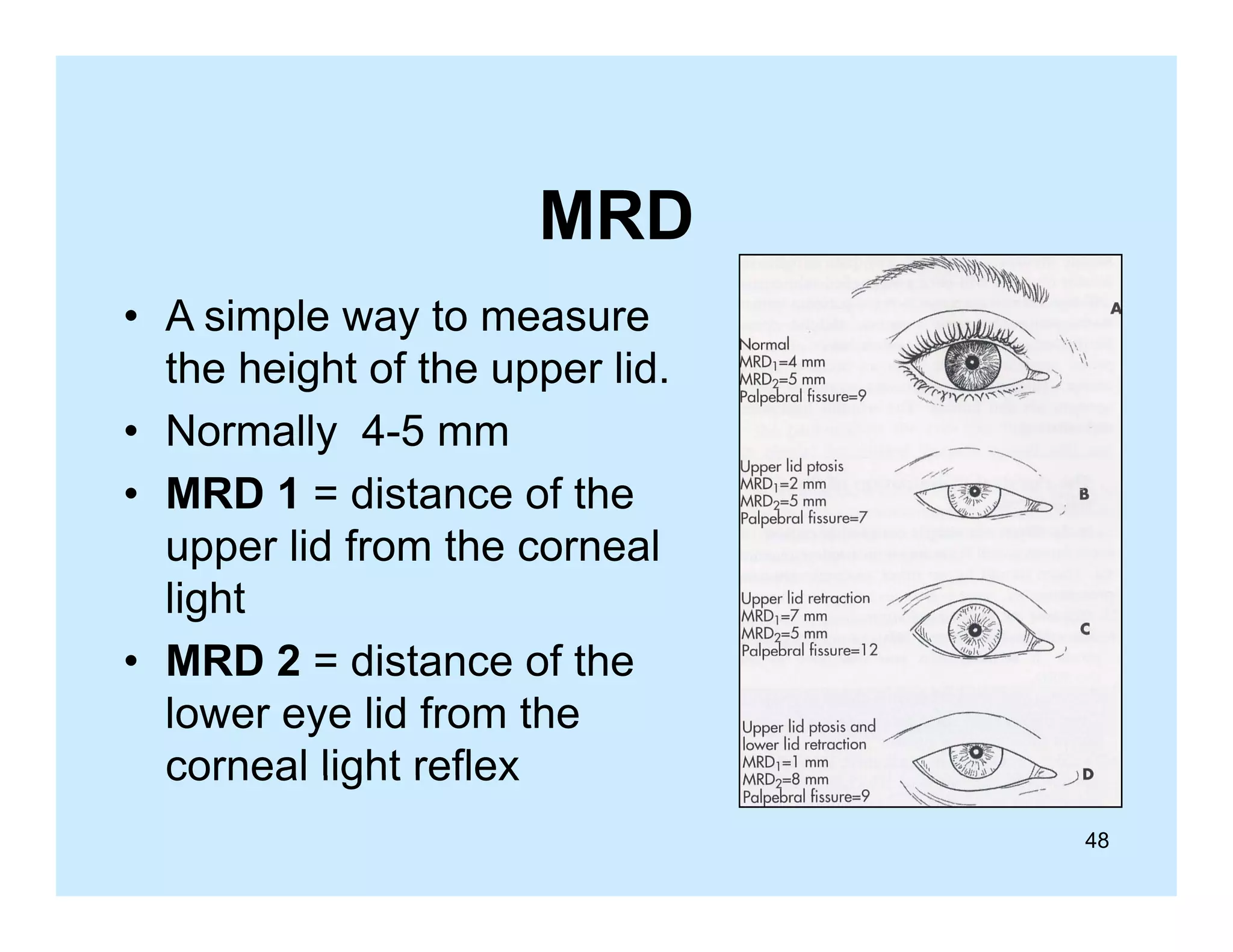 MRD
• A simple way to measure
the height of the upper lid.
• N
Normally 4 5 mm
ll 4-5
• MRD 1 = distance of the
upper lid f
from th corneal
the
l
light
• MRD 2 = distance of the
lower eye lid from the
corneal light reflex
48

 