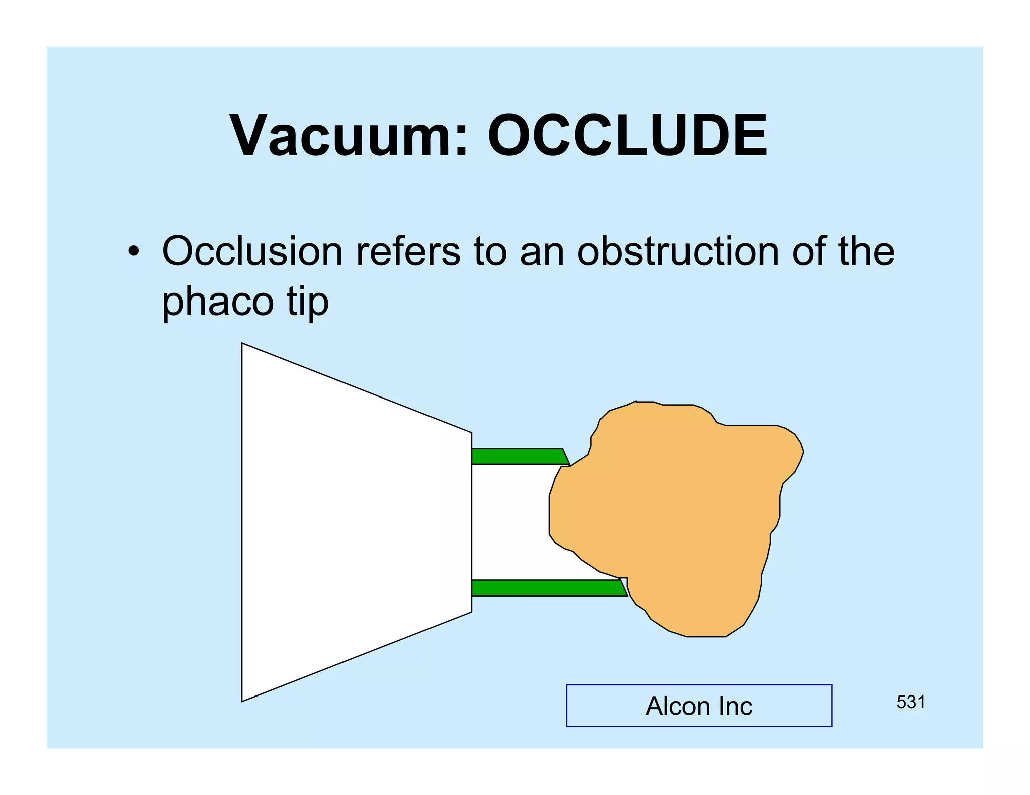 Vacuum: OCCLUDE
• Occlusion refers to an obstruction of the
phaco tip

Alcon Inc

531

 