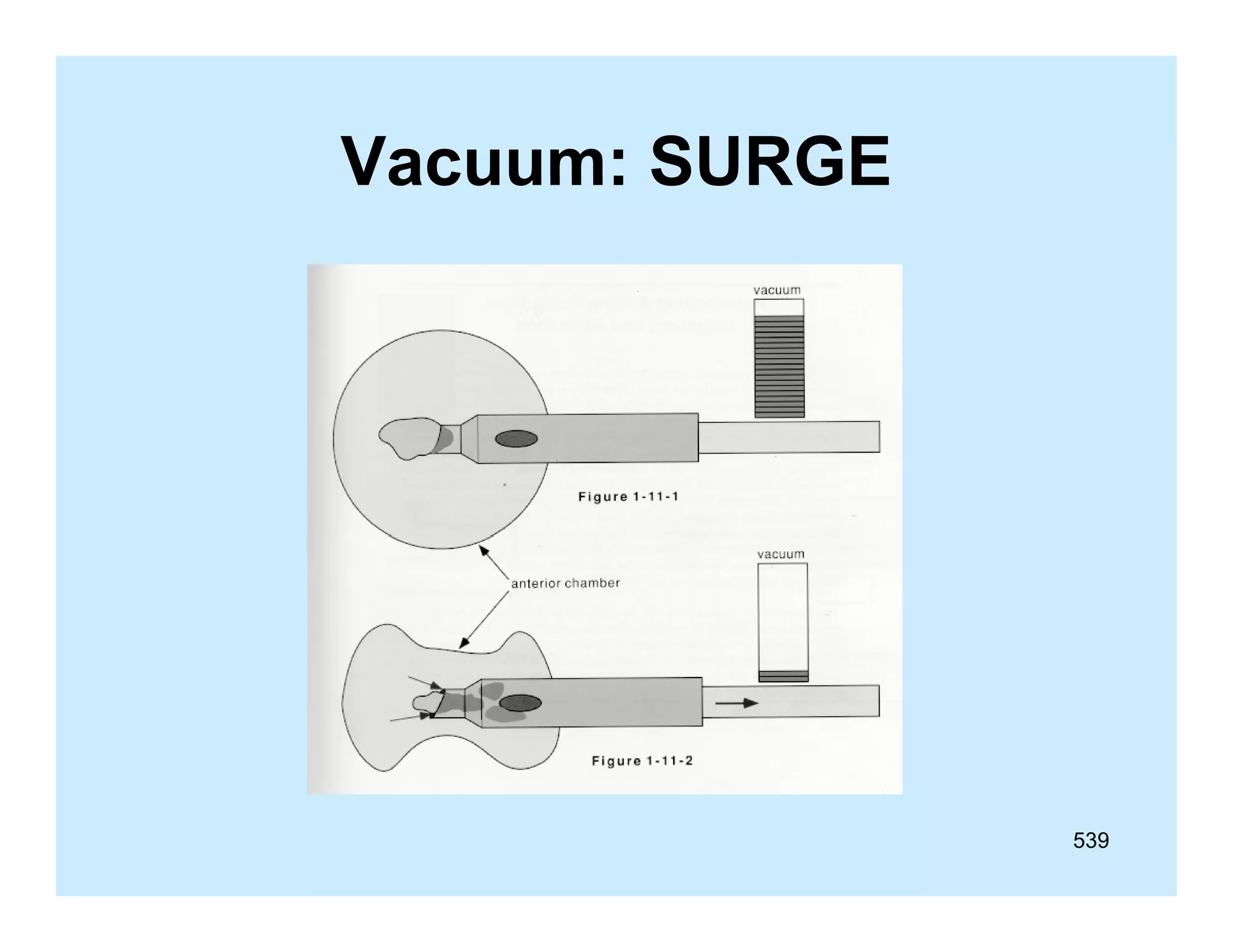 Vacuum: SURGE

539

 