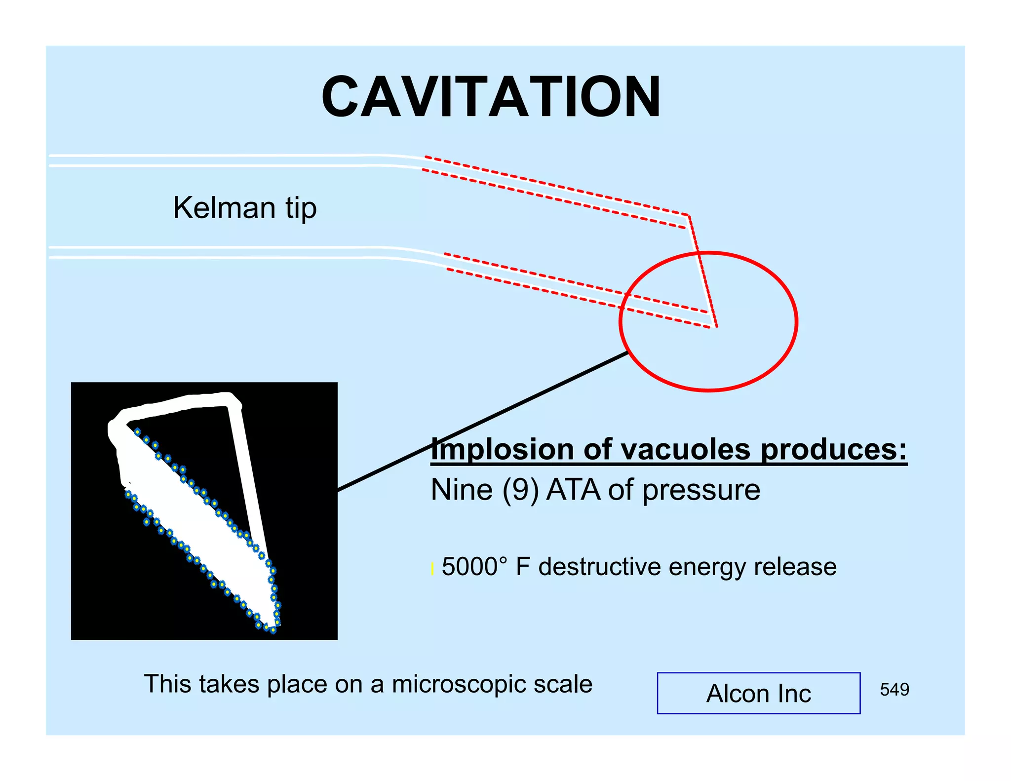 CAVITATION
Kelman tip

Implosion f
I l i of vacuoles produces:
l
d
Nine (9) ATA of pressure
l

5000° F destructive energy release

This takes place on a microscopic scale

Alcon Inc

549

 