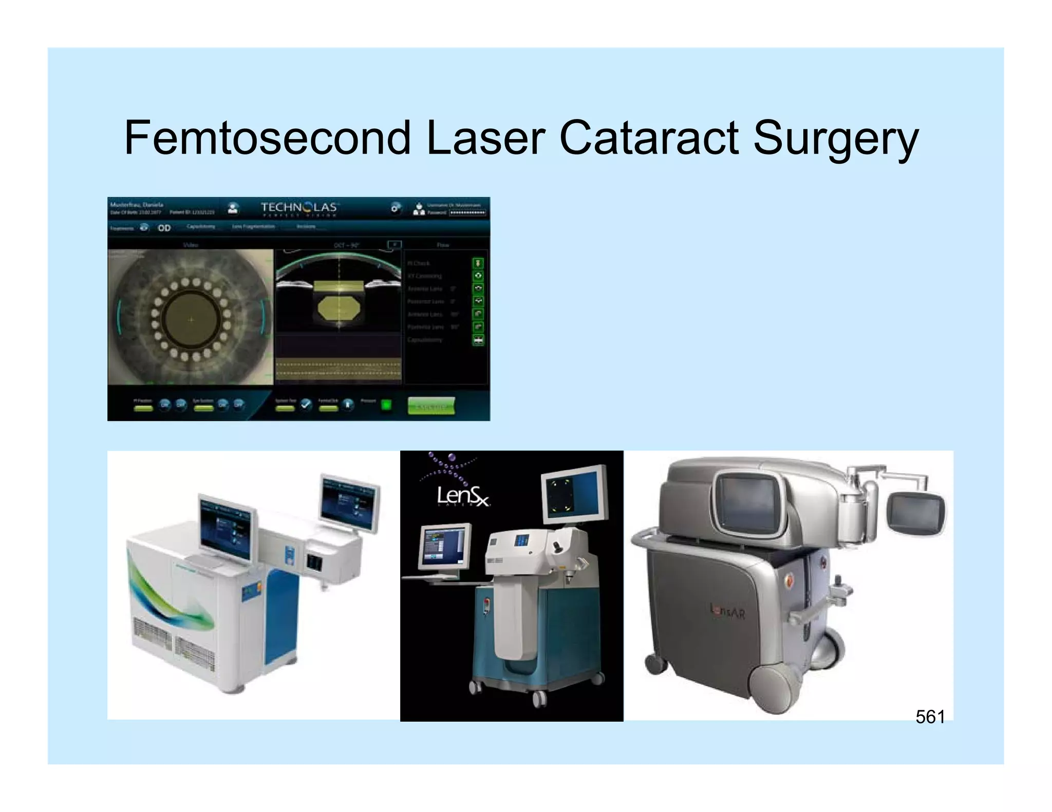 Femtosecond Laser Cataract Surgery

561

 