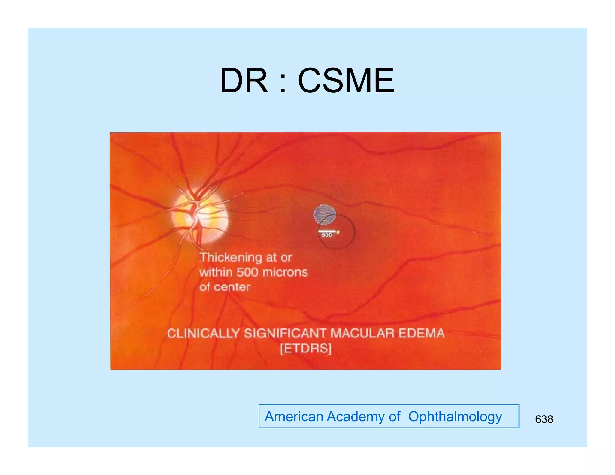 DR : CSME

American Academy of Ophthalmology

638

 