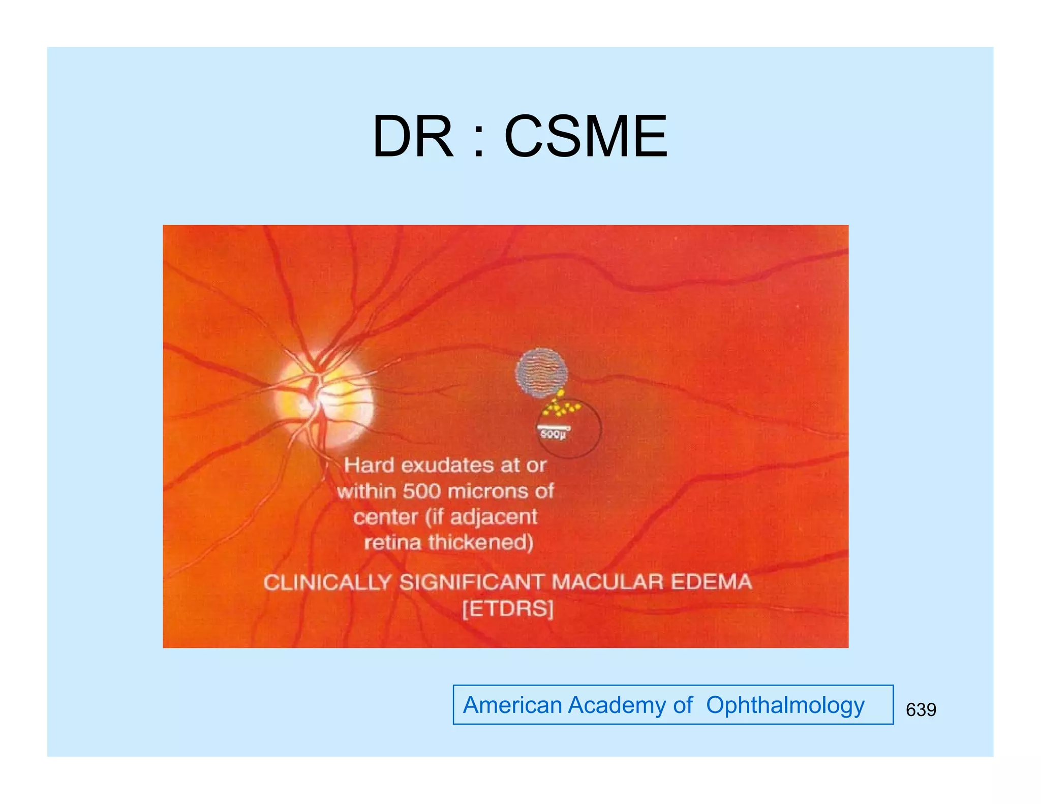 DR : CSME

American Academy of Ophthalmology

639

 