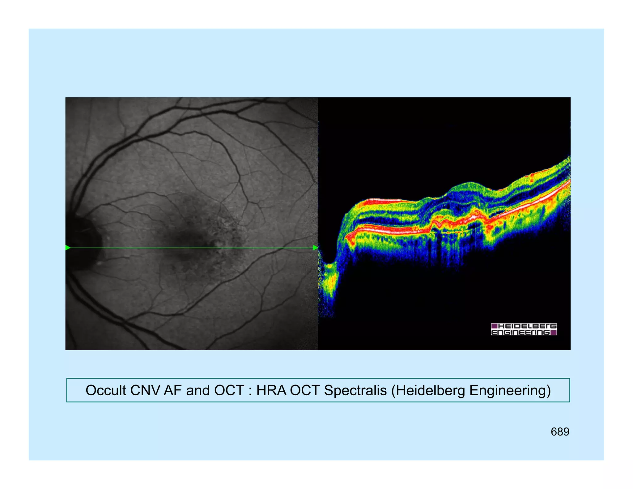 Occult CNV AF and OCT : HRA OCT Spectralis (Heidelberg Engineering)
689

 