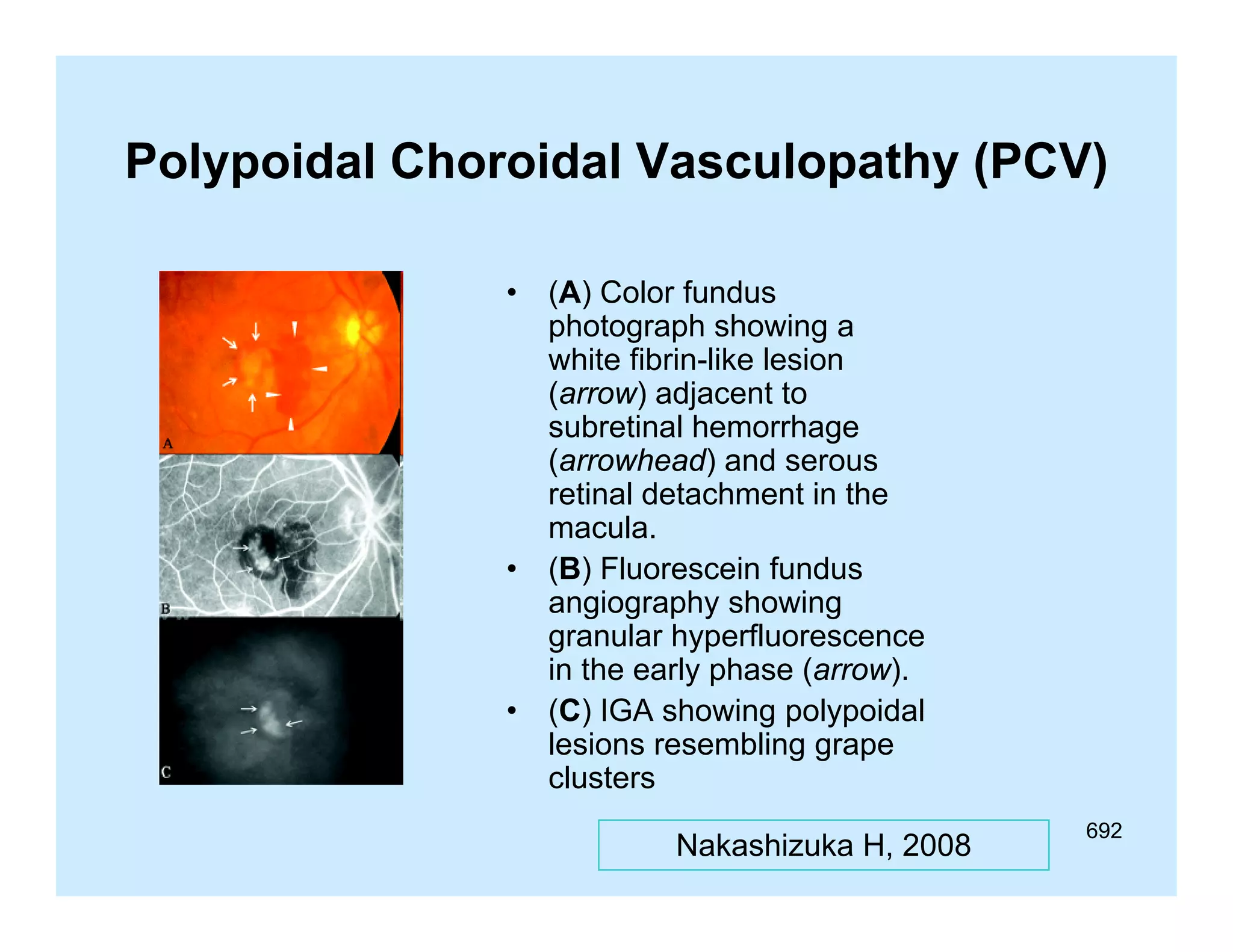 Polypoidal Choroidal Vasculopathy (PCV)
•

•

•

(A) Color fundus
photograph showing a
white fibrin-like lesion
(arrow) adjacent to
subretinal h
b ti l hemorrhage
h
(arrowhead) and serous
retinal detachment in the
macula.
(B) Fluorescein fundus
angiography showing
granular hyperfluorescence
in the early phase (arrow).
(C) IGA showing polypoidal
lesions resembling grape
clusters
Nakashizuka H, 2008

692

 