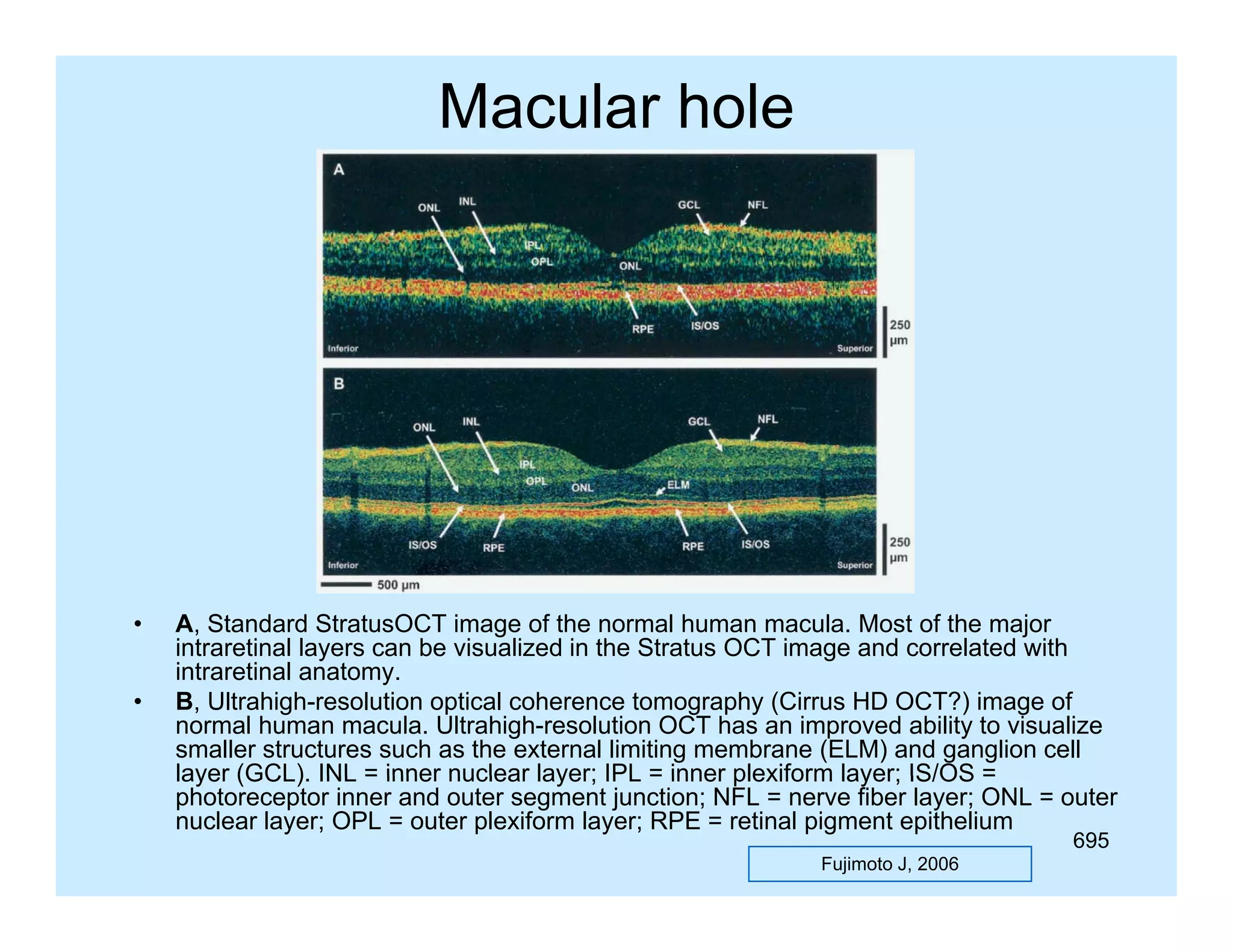 Macular hole

•
•

A, Standard StratusOCT image of the normal human macula. Most of the major
intraretinal layers can be visualized in the Stratus OCT image and correlated with
intraretinal anatomy.
B, Ultrahigh-resolution optical coherence tomography (Cirrus HD OCT?) image of
normal human macula. Ultrahigh-resolution OCT has an improved ability to visualize
smaller structures such as the external limiting membrane (ELM) and ganglion cell
layer (GCL) INL = inner nuclear layer; IPL = inner plexiform layer; IS/OS =
(GCL).
photoreceptor inner and outer segment junction; NFL = nerve fiber layer; ONL = outer
nuclear layer; OPL = outer plexiform layer; RPE = retinal pigment epithelium
695

Fujimoto J, 2006

 