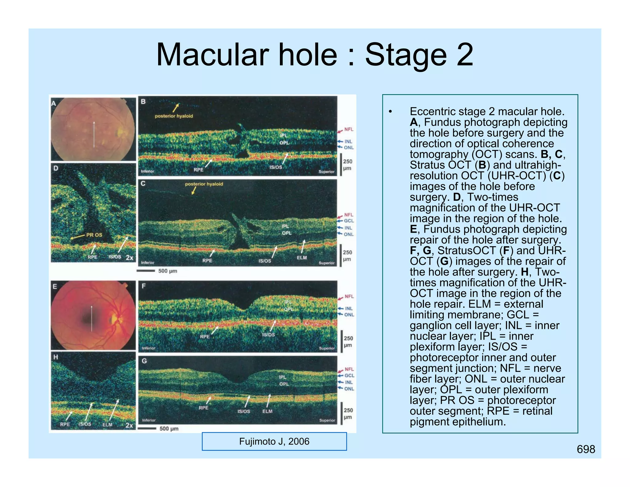 Macular hole : Stage 2
•

Fujimoto J, 2006

Eccentric stage 2 macular hole.
A, Fundus photograph depicting
the hole before surgery and the
direction of optical coherence
tomography (OCT) scans. B C
t
h
B, C,
Stratus OCT (B) and ultrahighresolution OCT (UHR-OCT) (C)
images of the hole before
surgery. D, Two-times
g
magnification of the UHR-OCT
image in the region of the hole.
E, Fundus photograph depicting
repair of the hole after surgery.
F, G, StratusOCT (F) and UHROCT (G) images of the repair of
the hole after surgery H Twosurgery. H, Two
times magnification of the UHROCT image in the region of the
hole repair. ELM = external
limiting membrane; GCL =
ganglion cell layer; INL = inner
nuclear layer; IPL = inner
plexiform layer; IS/OS =
photoreceptor inner and outer
segment junction; NFL = nerve
fiber layer; ONL = outer nuclear
layer; OPL = outer plexiform
layer; PR OS = photoreceptor
l
h t
t
outer segment; RPE = retinal
pigment epithelium.
698

 