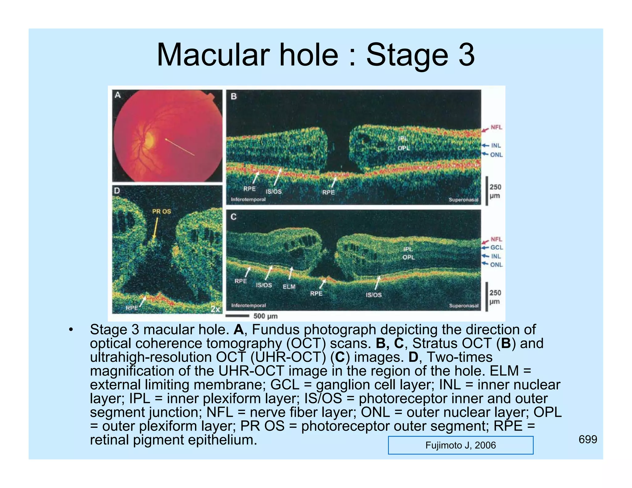 Macular hole : Stage 3

•

Stage 3 macular hole. A, Fundus photograph depicting the direction of
g
,
p
g p
p
g
optical coherence tomography (OCT) scans. B, C, Stratus OCT (B) and
ultrahigh-resolution OCT (UHR-OCT) (C) images. D, Two-times
magnification of the UHR-OCT image in the region of the hole. ELM =
external limiting membrane; GCL = ganglion cell layer; INL = inner nuclear
layer; IPL = inner plexiform layer; IS/OS = photoreceptor inner and outer
segment junction; NFL = nerve fiber layer; ONL = outer nuclear layer; OPL
= outer plexiform layer; PR OS = photoreceptor outer segment; RPE =
retinal pigment epithelium.
Fujimoto J, 2006

699

 