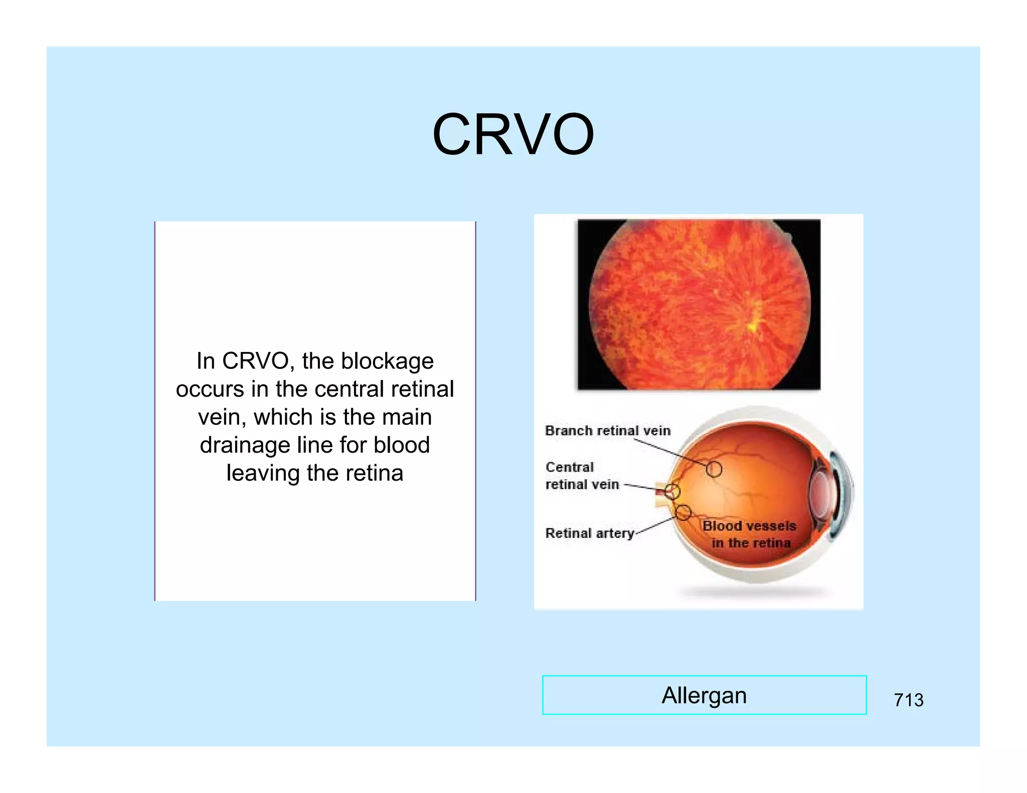 CRVO

In CRVO, the blockage
occurs in the central retinal
vein, which is the main
drainage line for blood
leaving the retina

Allergan

713

 