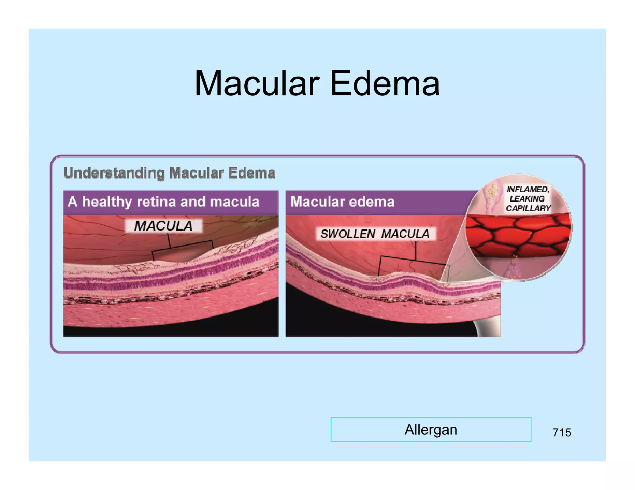 Macular Edema

Allergan

715

 