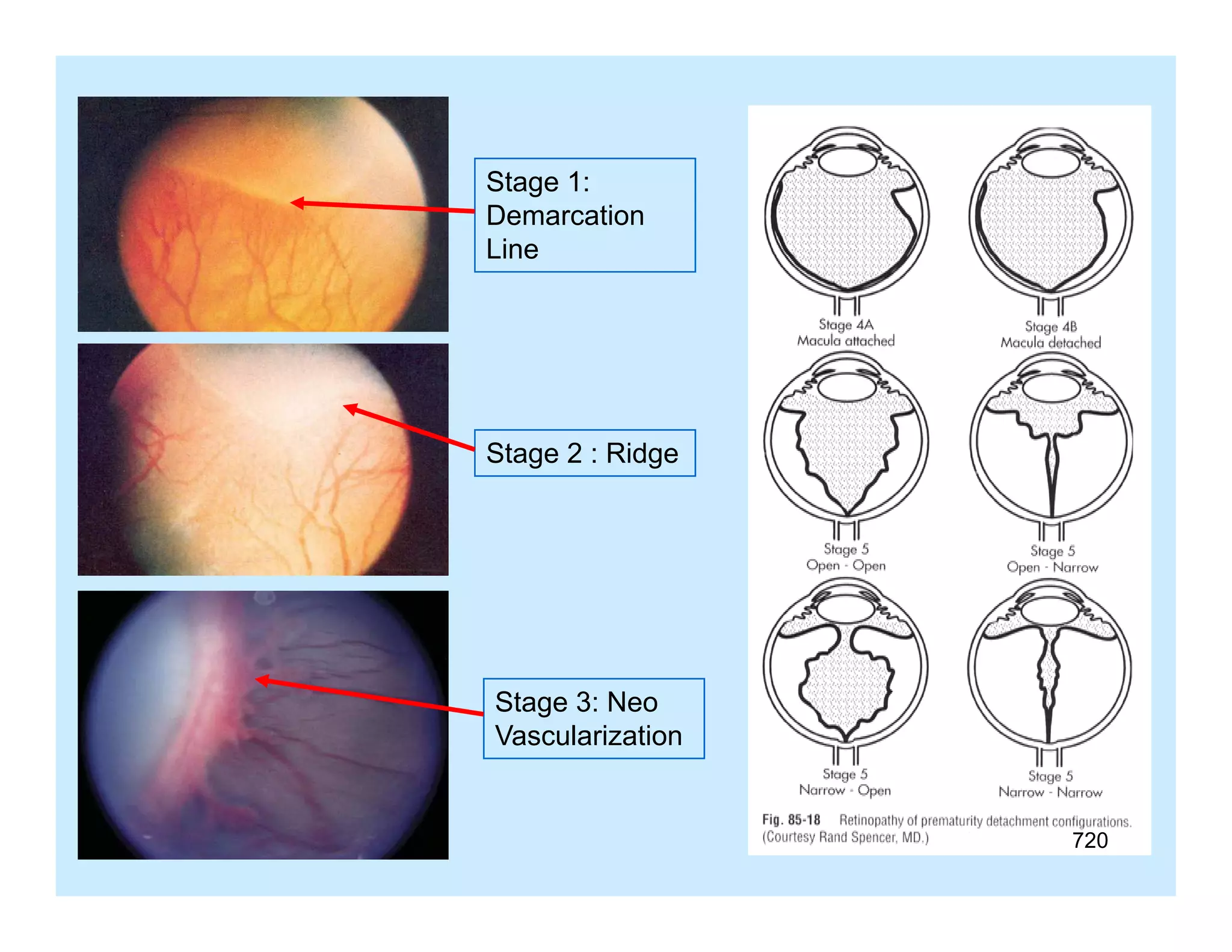 Stage 1:
St
1
Demarcation
Line

Stage 2 : Ridge

Stage 3: Neo
Vascularization

720

 