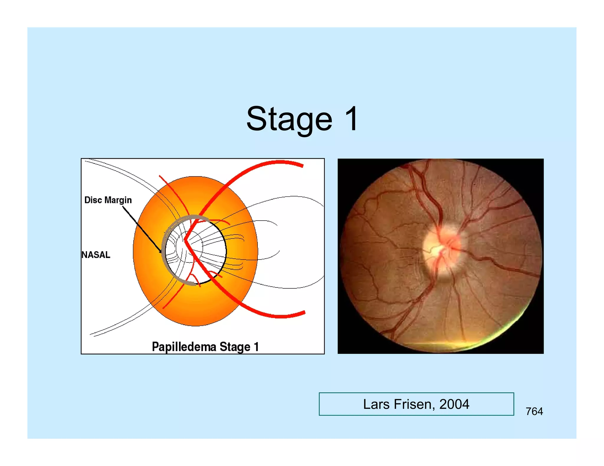 Stage 1

Lars Frisen, 2004

764

 